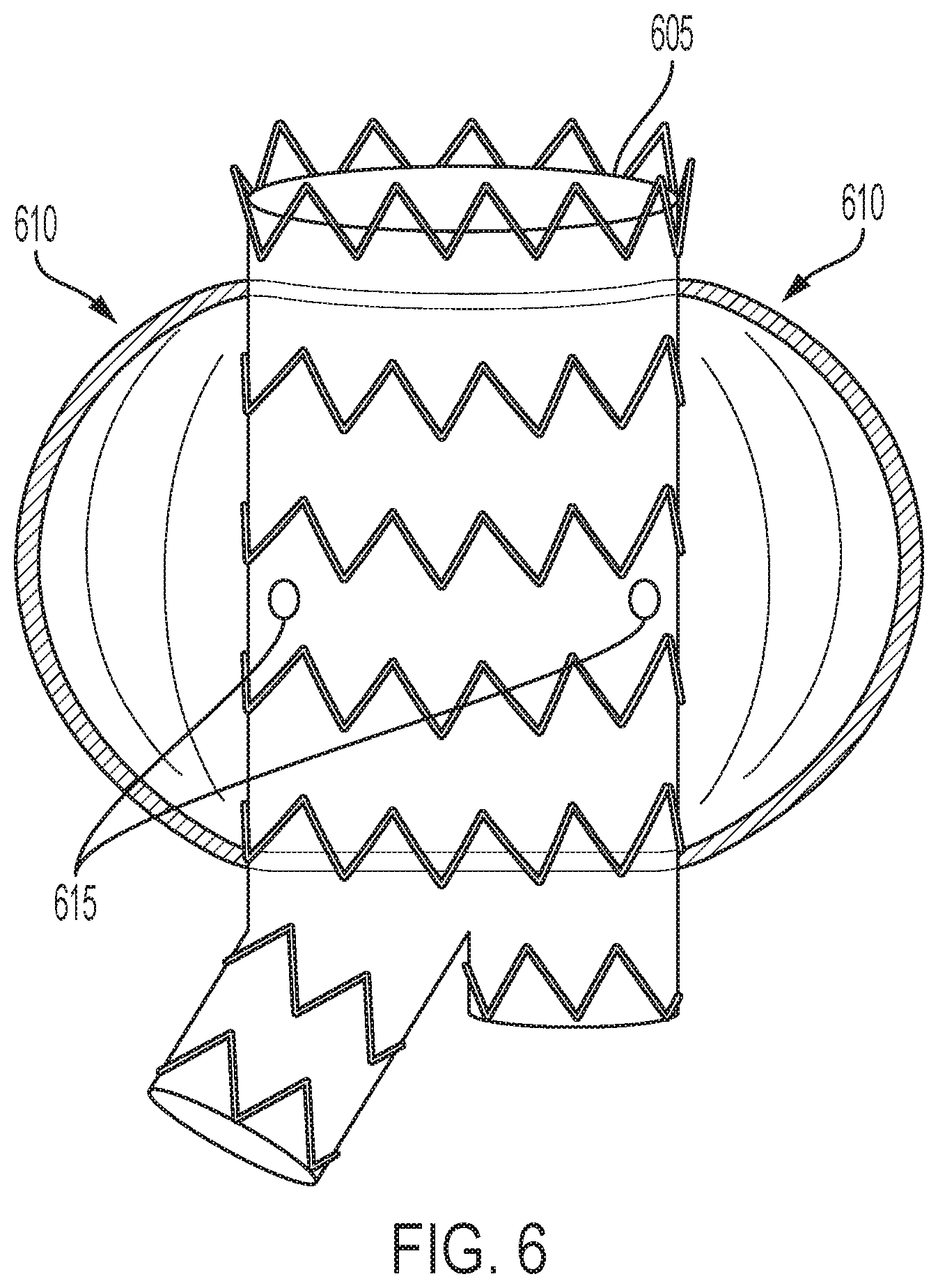 Patent US12102522 Figure 6 – Endovascular stent graft
