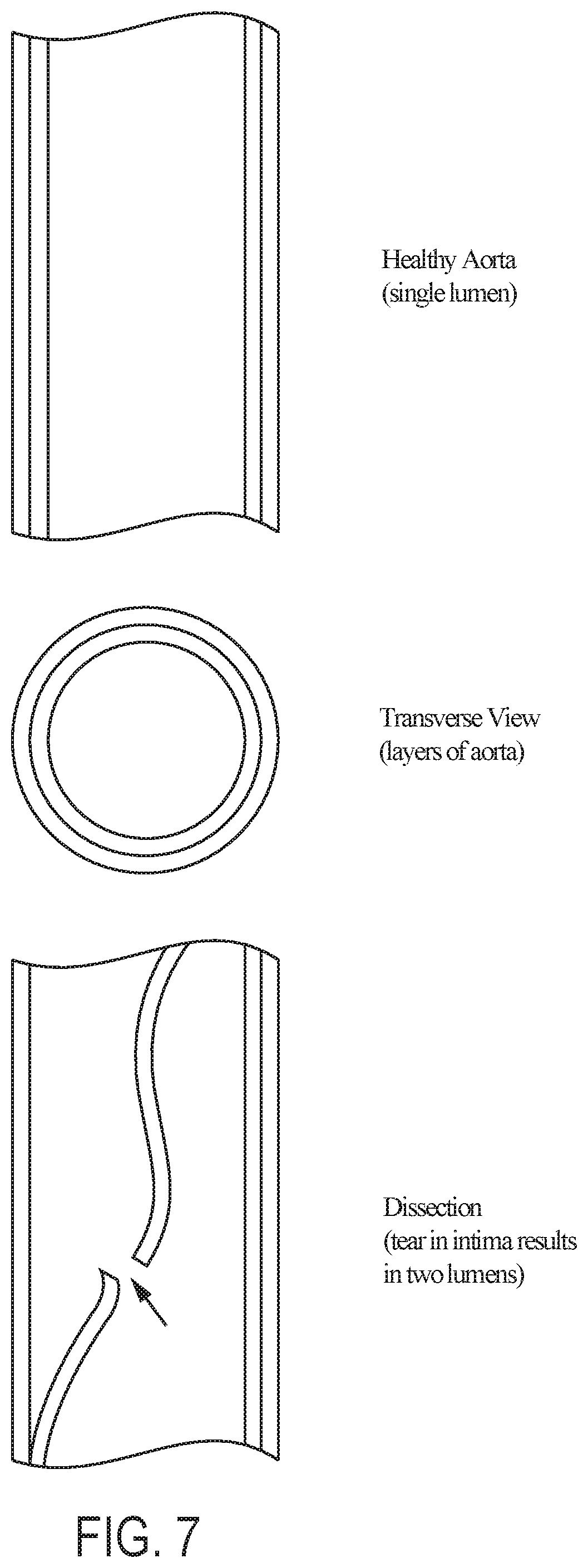 Patent US12102522 Figure 7 – Endovascular stent graft