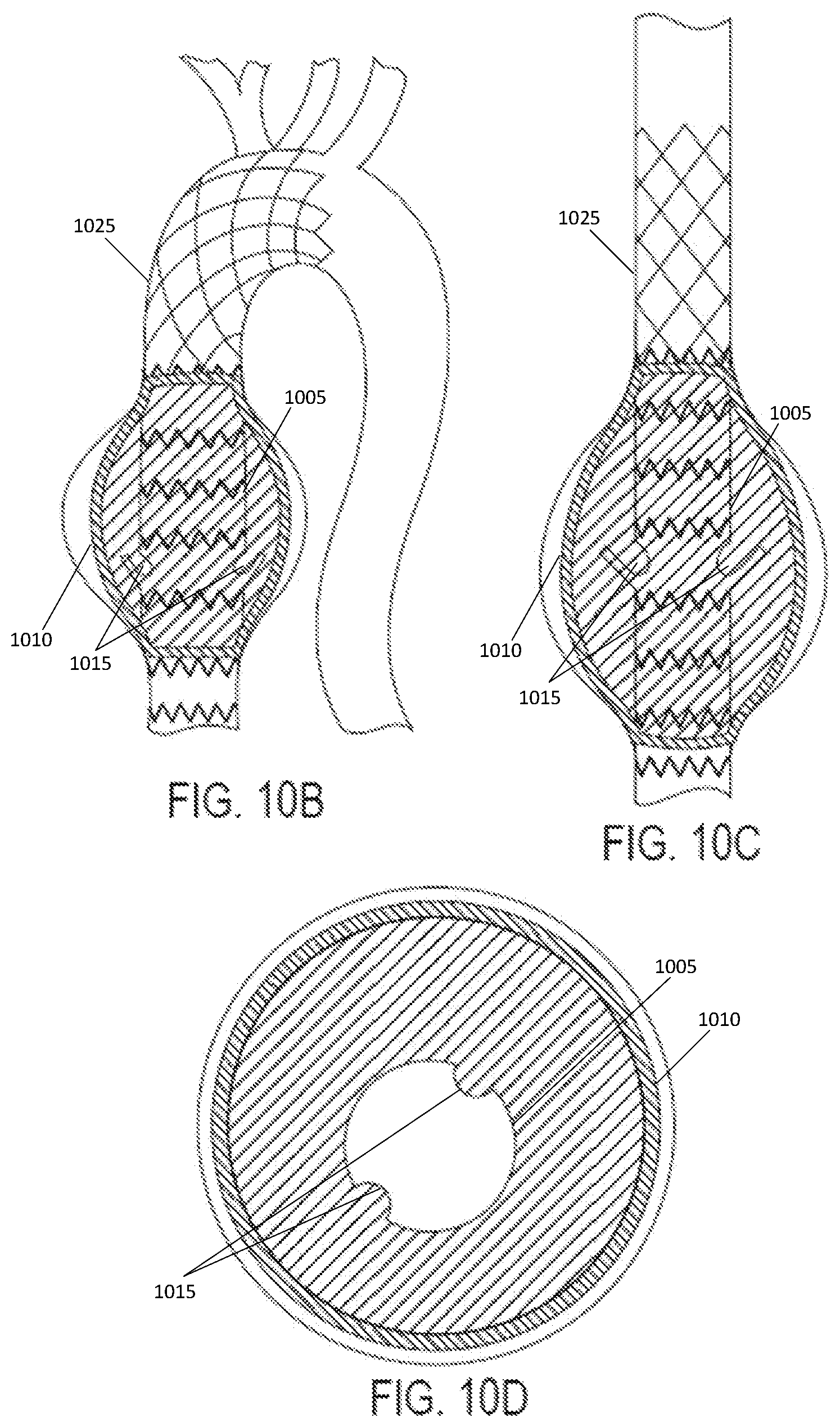 Patent US12102522 Figure 11 – Endovascular stent graft