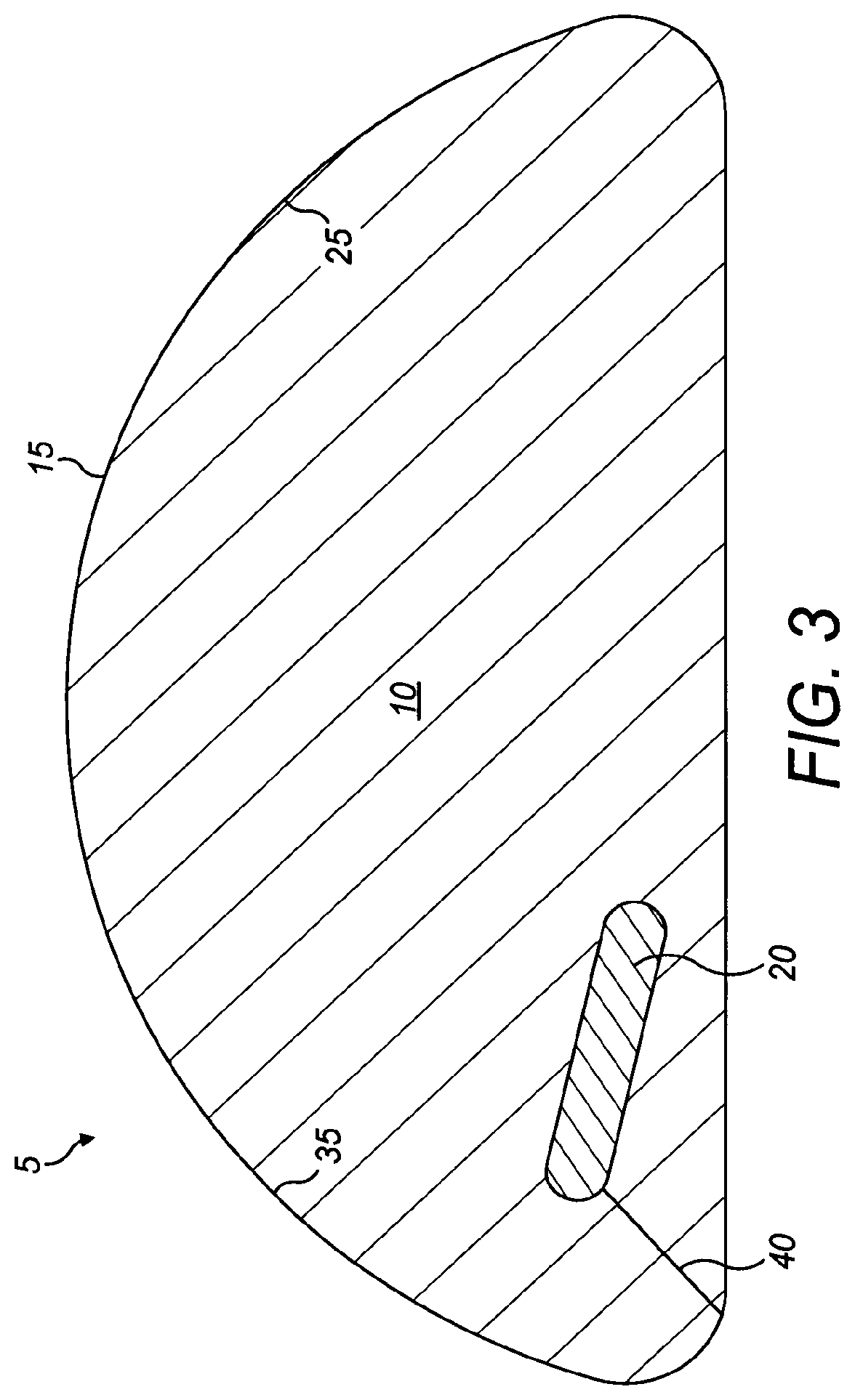 Patent US12102523 Figure 3 – Implant