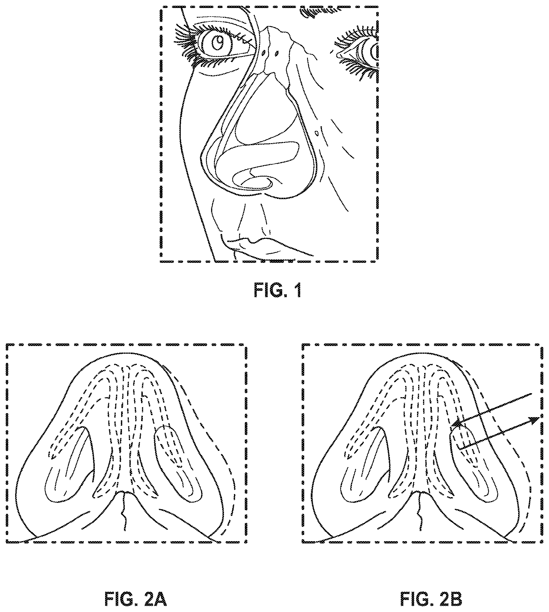Patent US12102525 Figure 1 – Nasal implants, delivery tools, systems, and methods of use
