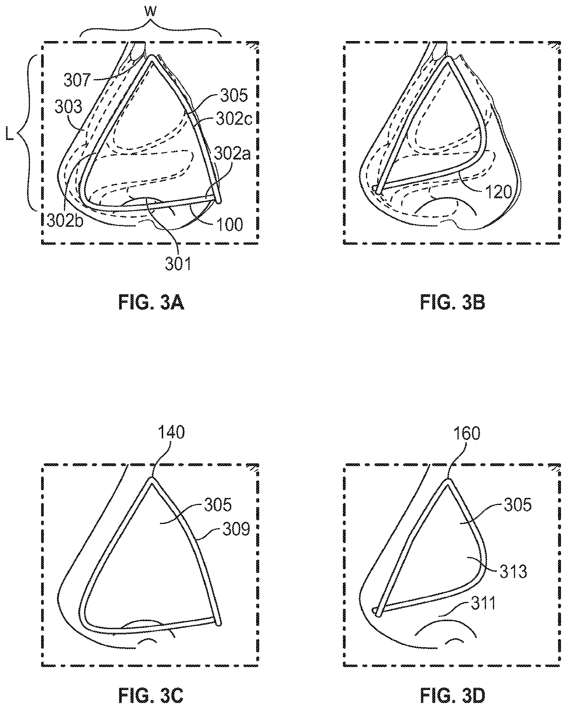 Patent US12102525 Figure 2 – Nasal implants, delivery tools, systems, and methods of use