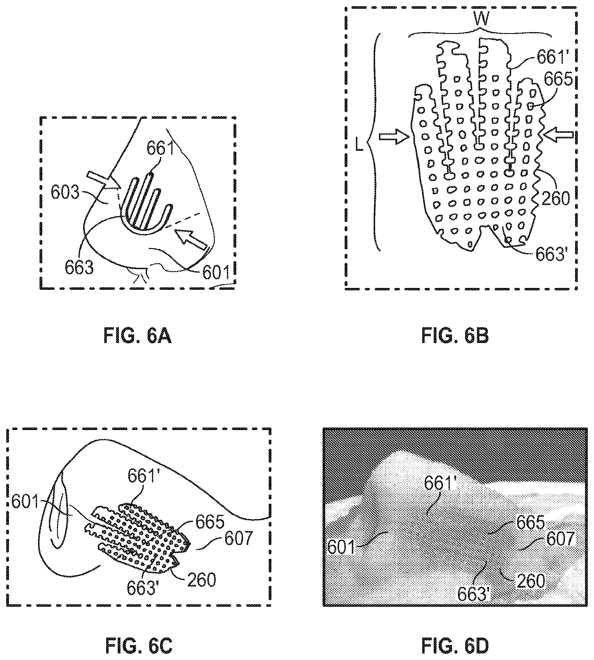 Patent US12102525 Figure 4 – Nasal implants, delivery tools, systems, and methods of use