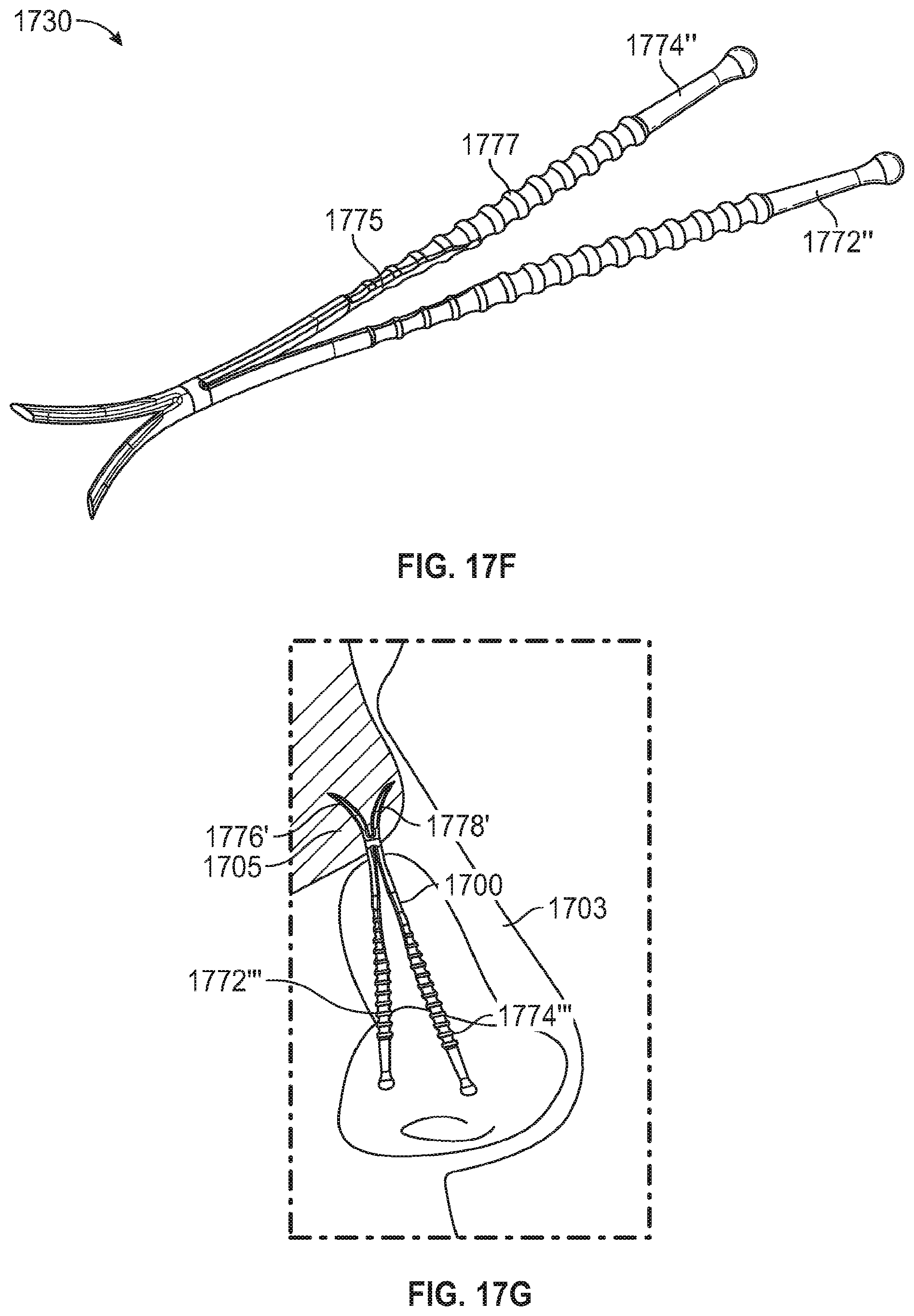Patent US12102525 Figure 16 – Nasal implants, delivery tools, systems, and methods of use