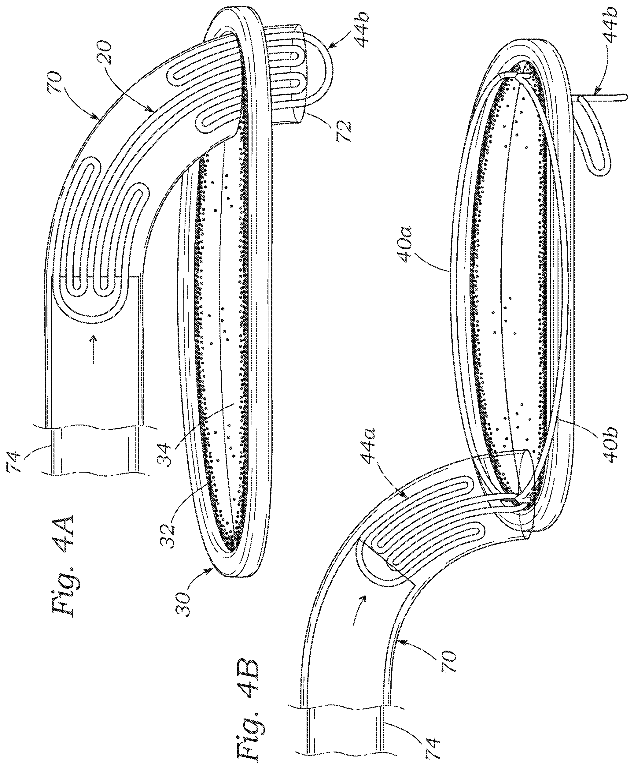 Patent US12102526 Figure 4 – Docking station for heart valve prosthesis