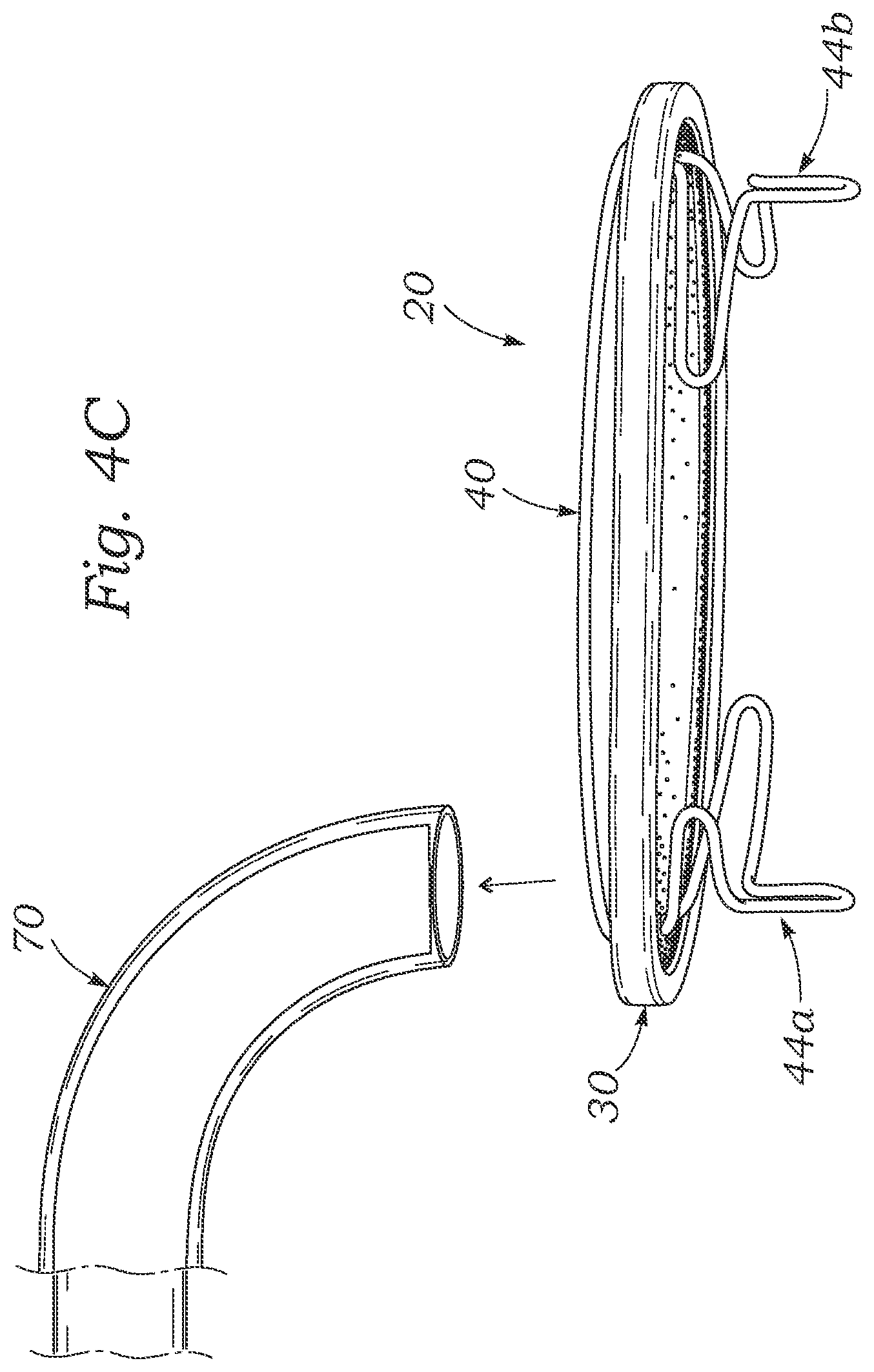 Patent US12102526 Figure 5 – Docking station for heart valve prosthesis