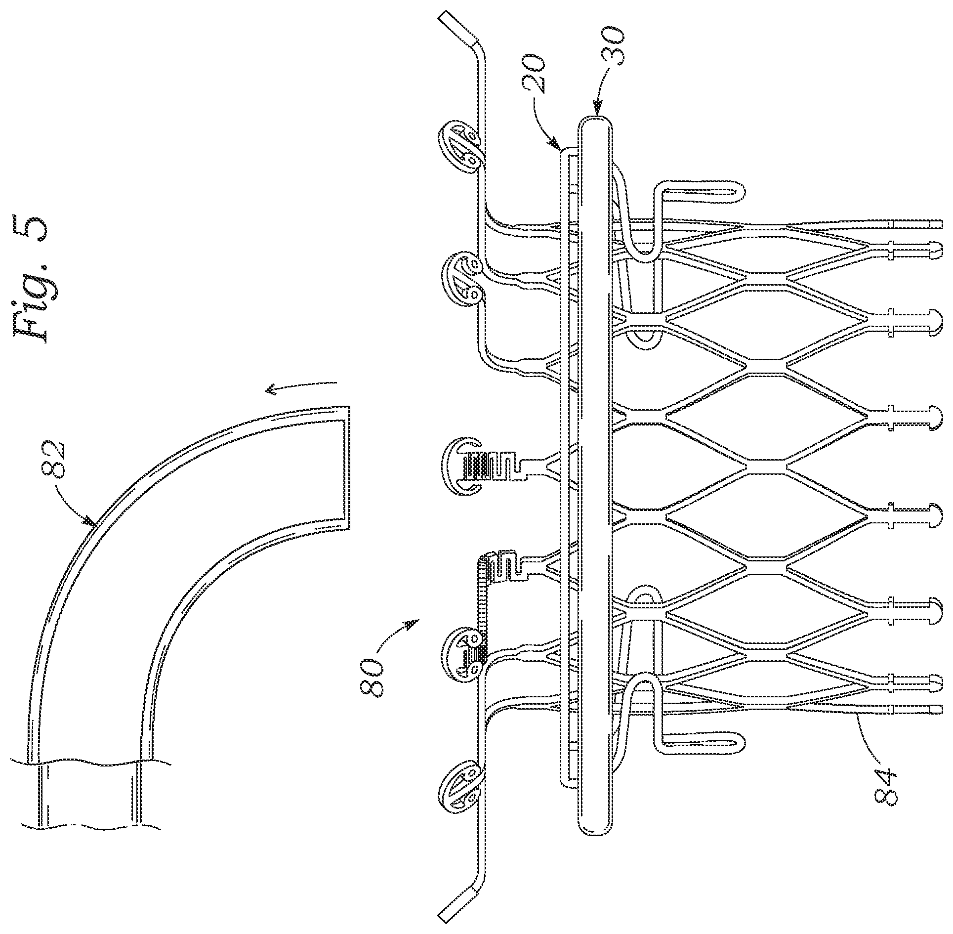Patent US12102526 Figure 6 – Docking station for heart valve prosthesis