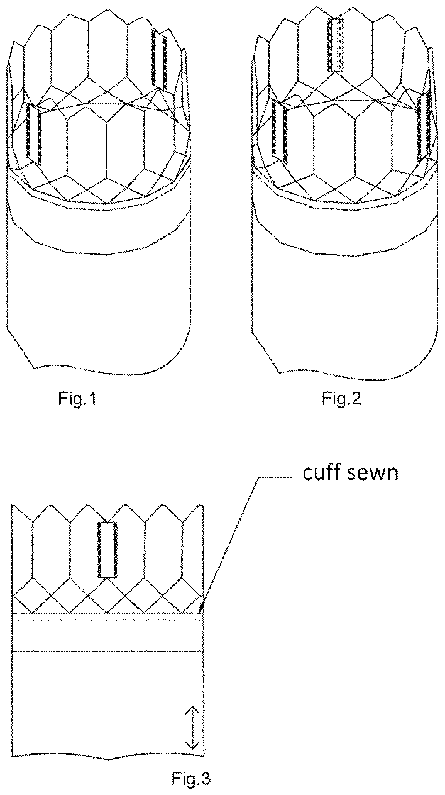 Patent US12102527 Figure 1 – Biological low profile, balloon expandable prosthetic heart valve, particularly aortic, for transcatheter implantation and the method of its manufacturing