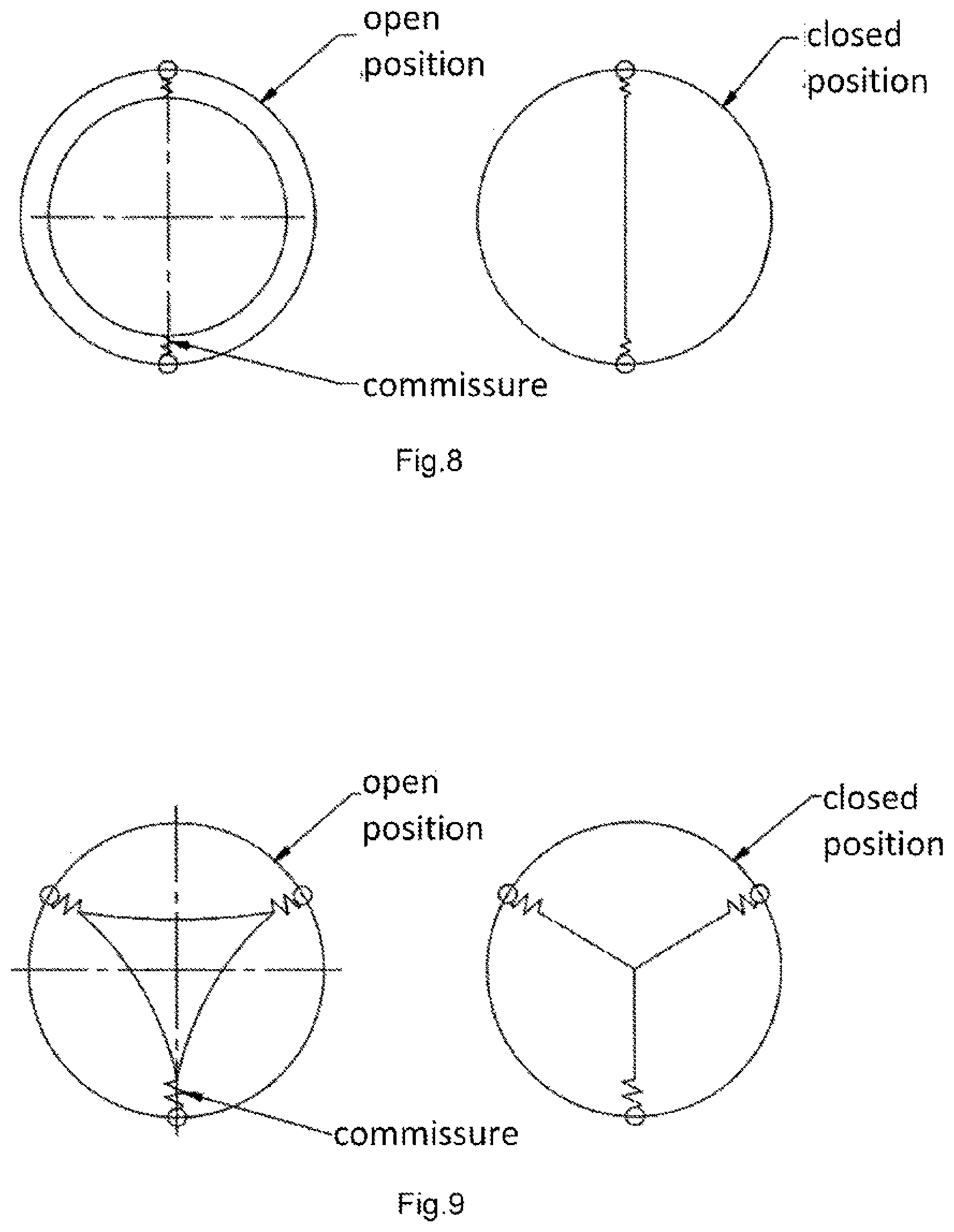 Patent US12102527 Figure 3 – Biological low profile, balloon expandable prosthetic heart valve, particularly aortic, for transcatheter implantation and the method of its manufacturing
