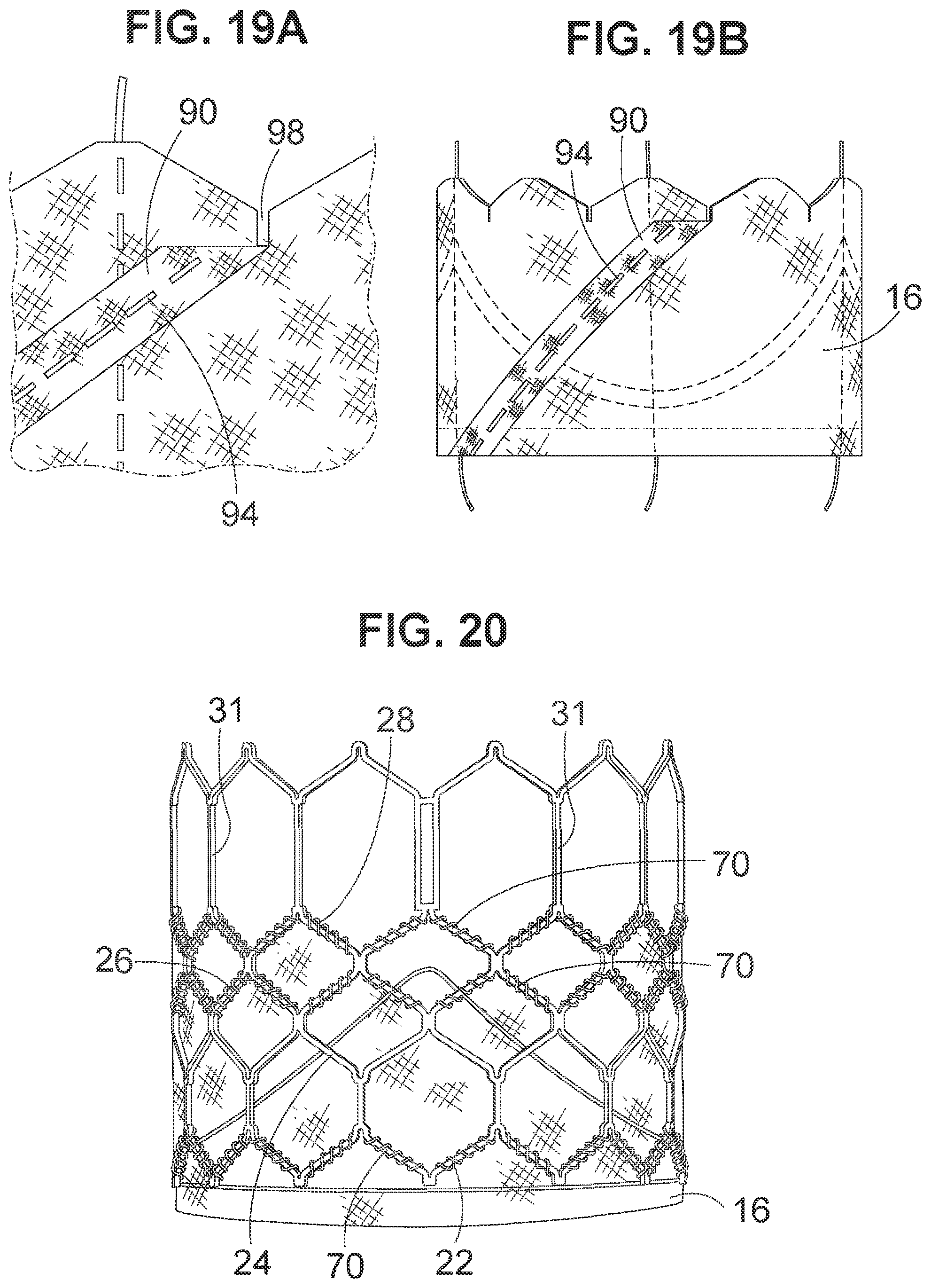 Patent US12102528 Figure 6 – Prosthetic heart valve