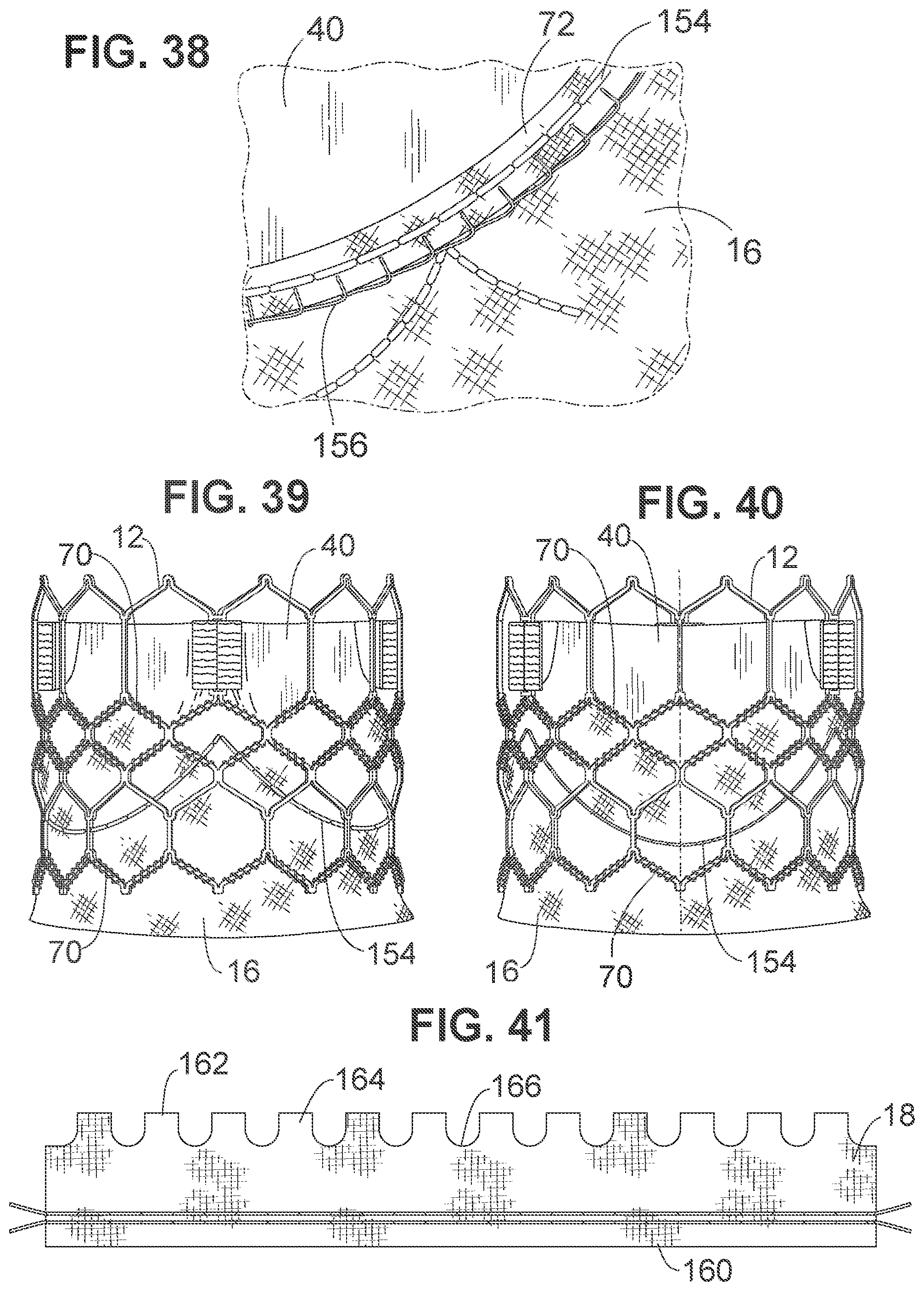 Patent US12102528 Figure 14 – Prosthetic heart valve