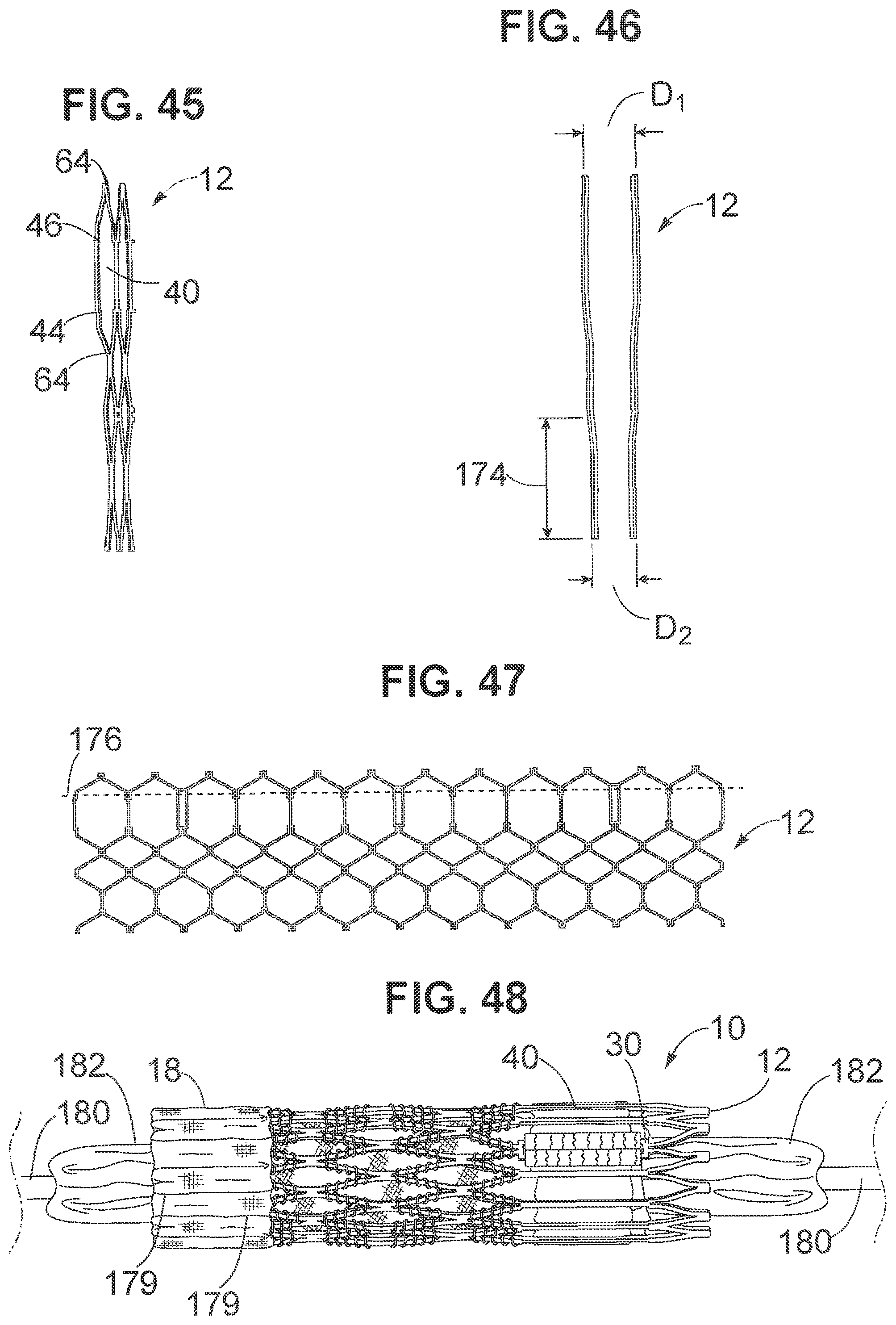 Patent US12102528 Figure 17 – Prosthetic heart valve