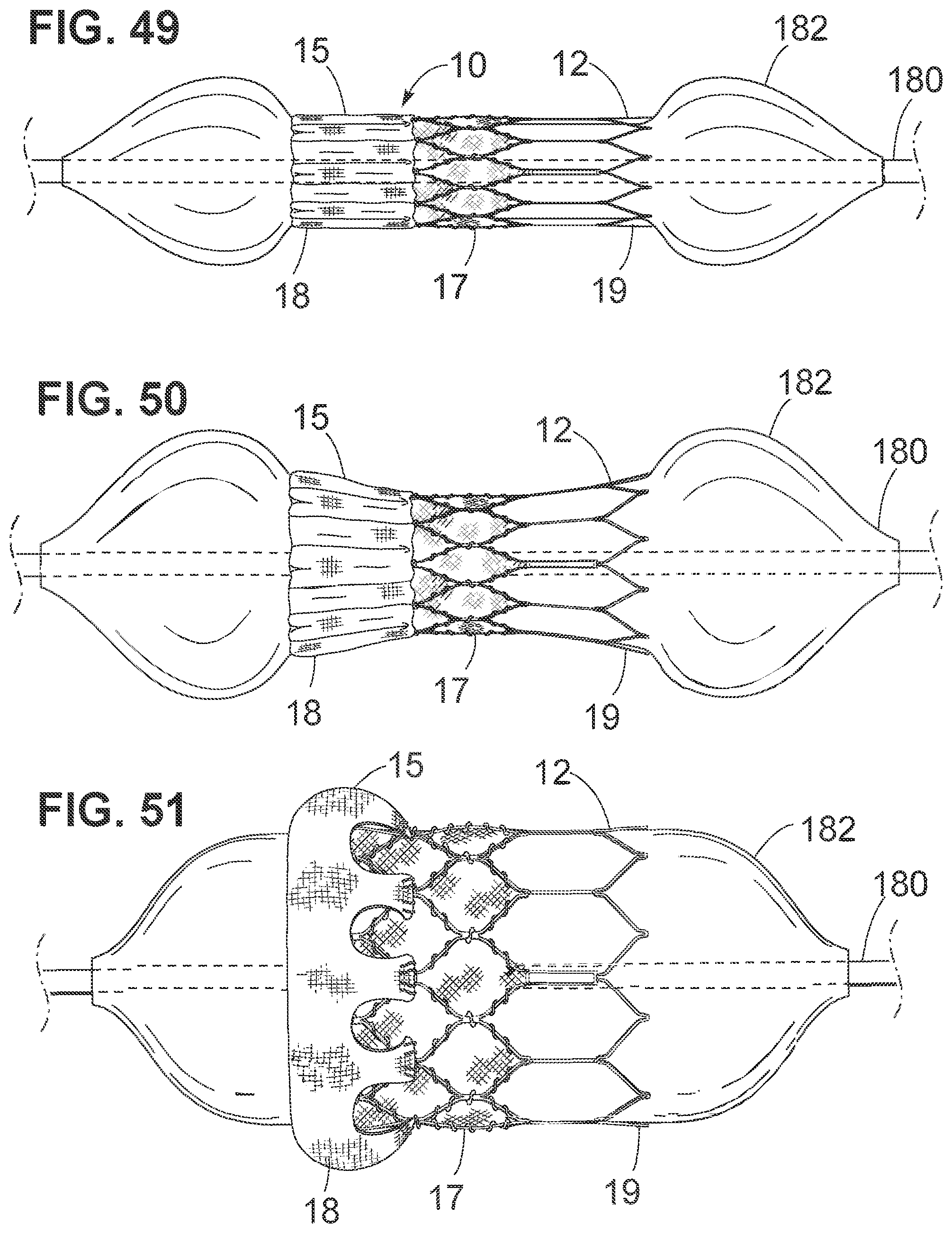 Patent US12102528 Figure 18 – Prosthetic heart valve