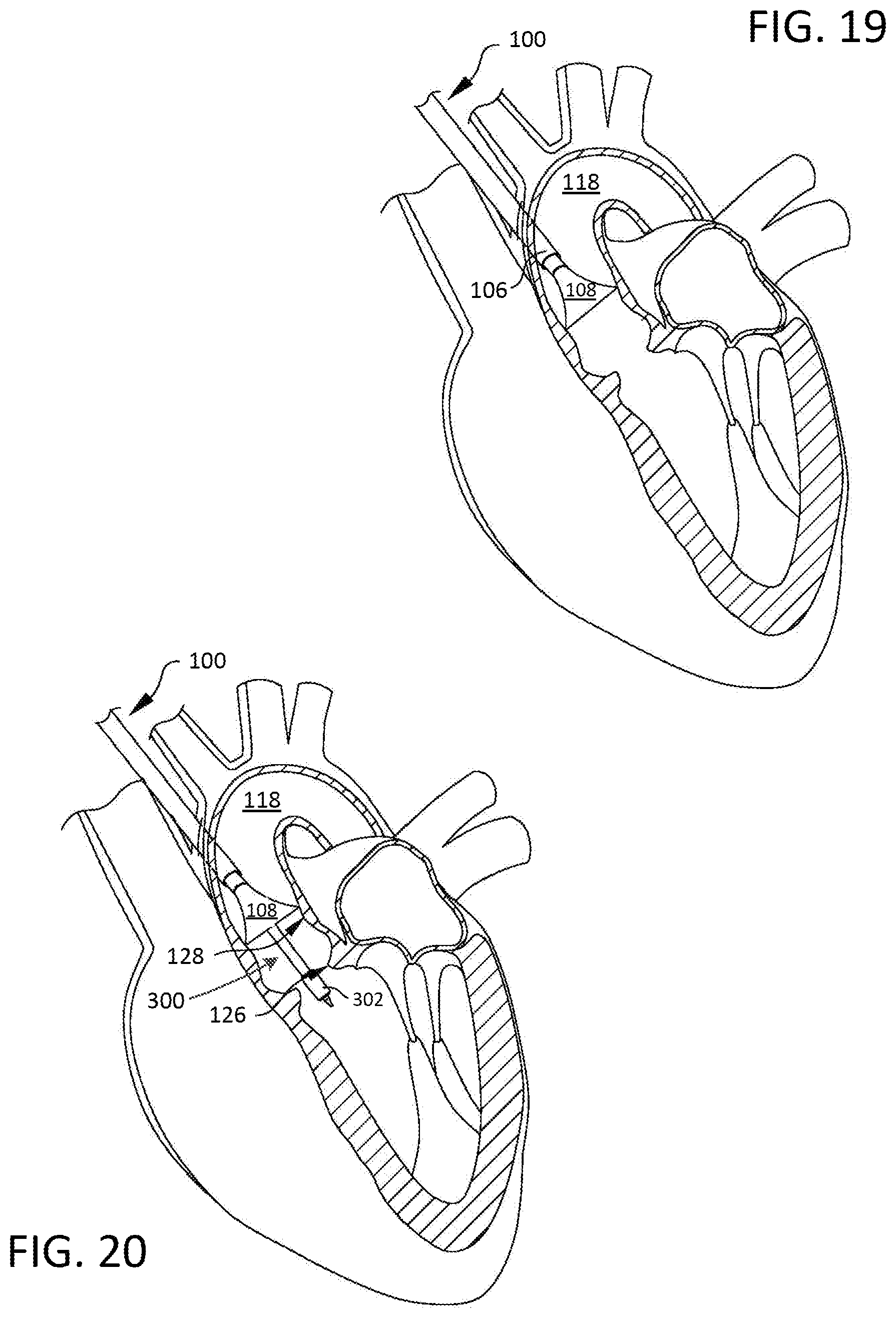 Patent US12102529 Figure 19 – Valve replacement devices and methods