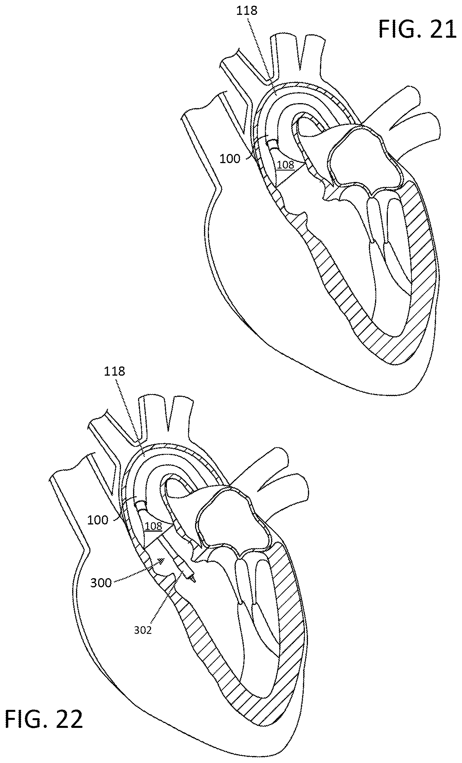 Patent US12102529 Figure 20 – Valve replacement devices and methods