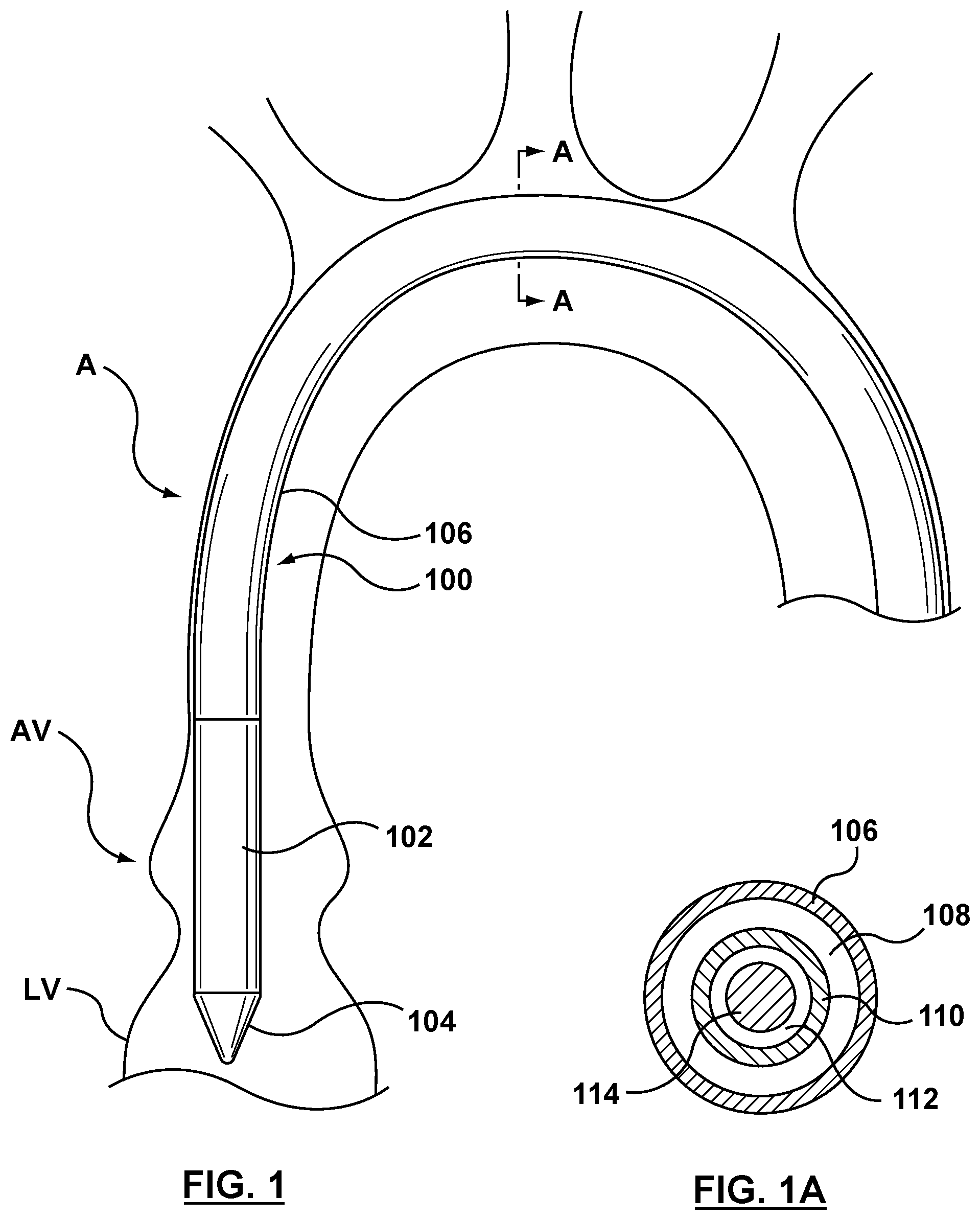 Patent US12102530 Figure 1 – Delivery system having an integral centering mechanism for positioning a valve prosthesis in situ