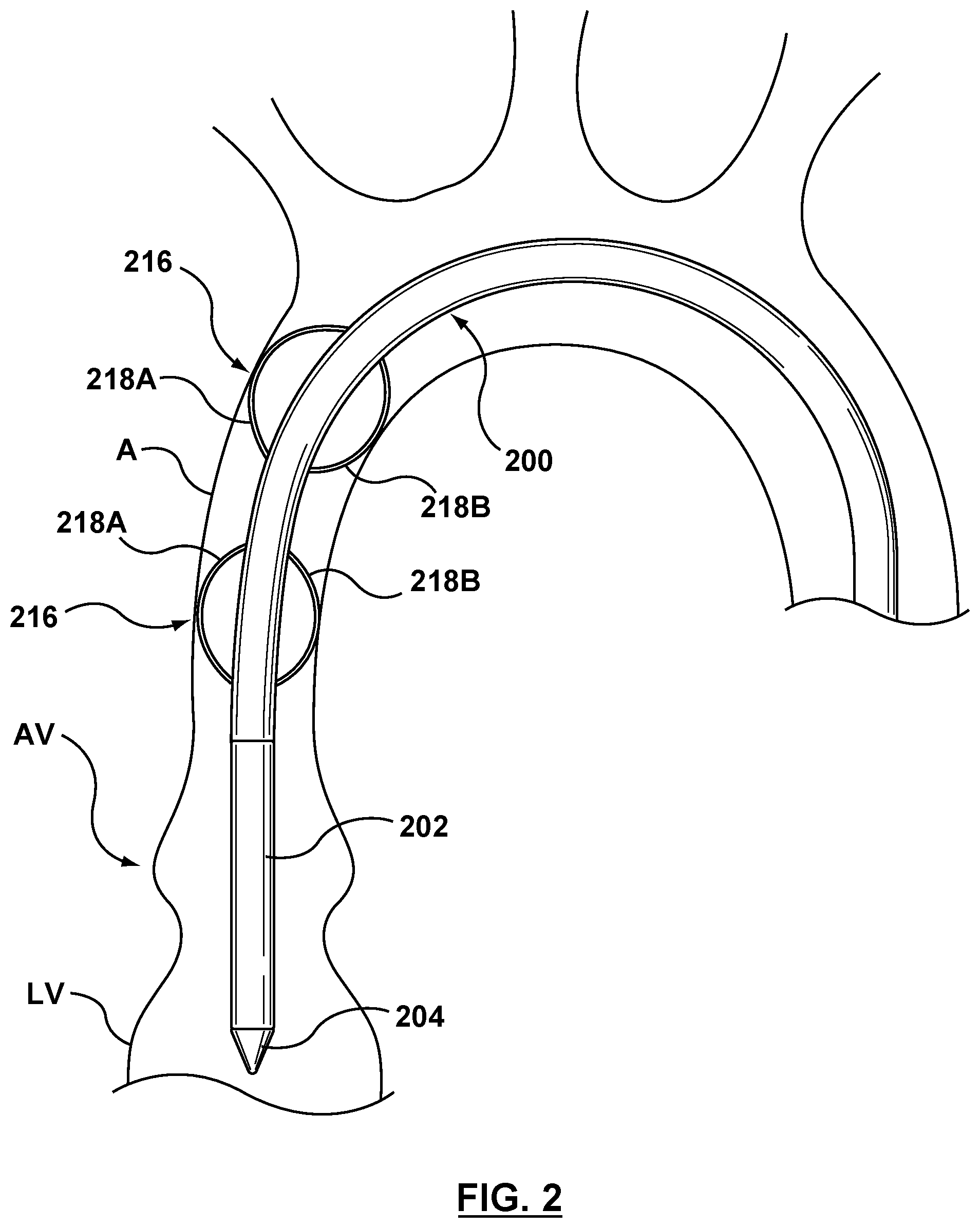 Patent US12102530 Figure 2 – Delivery system having an integral centering mechanism for positioning a valve prosthesis in situ
