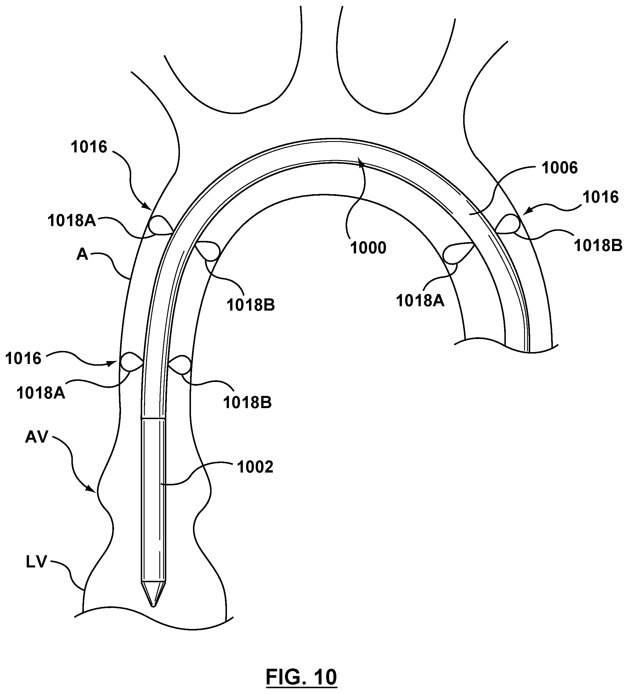 Patent US12102530 Figure 7 – Delivery system having an integral centering mechanism for positioning a valve prosthesis in situ