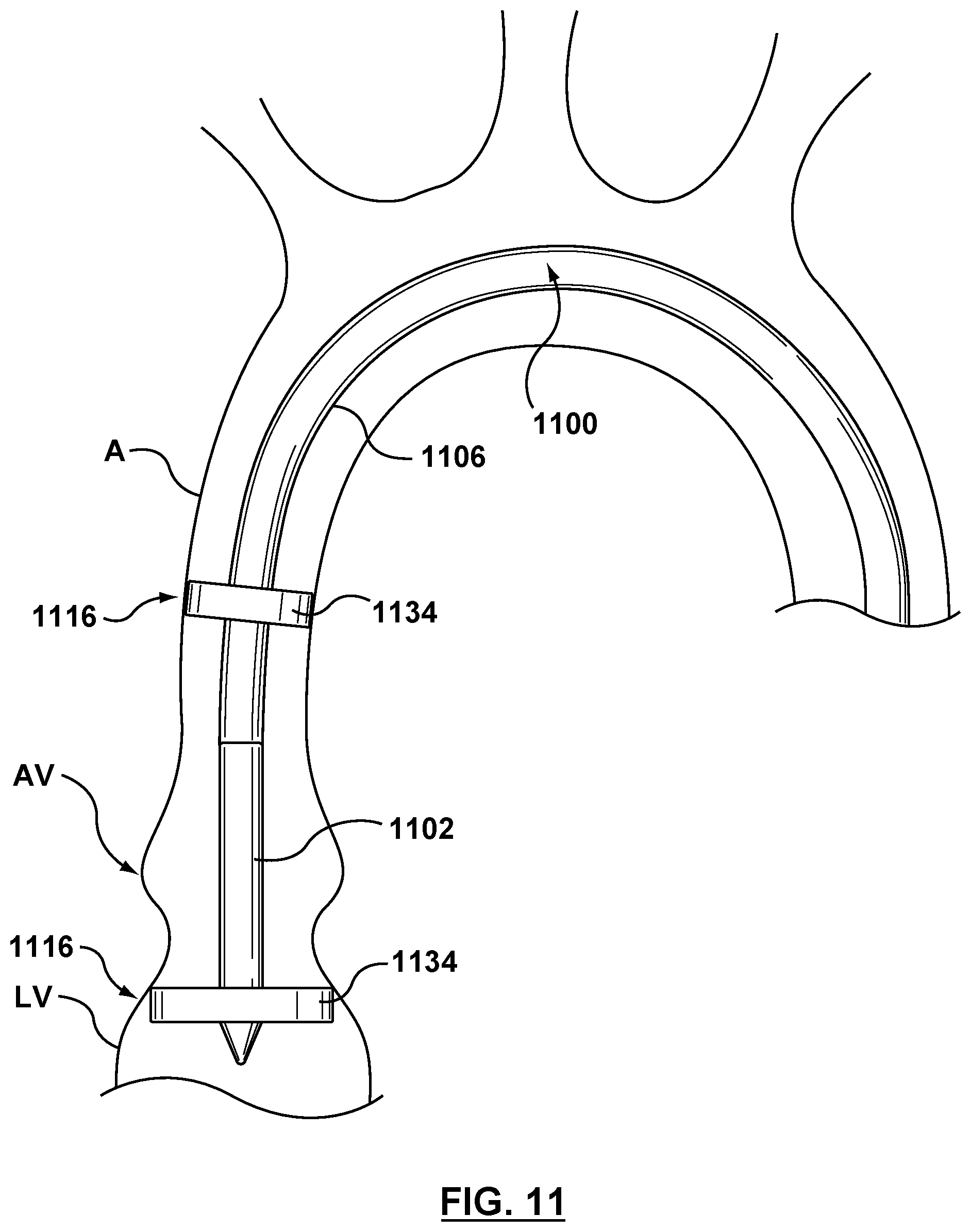 Patent US12102530 Figure 8 – Delivery system having an integral centering mechanism for positioning a valve prosthesis in situ