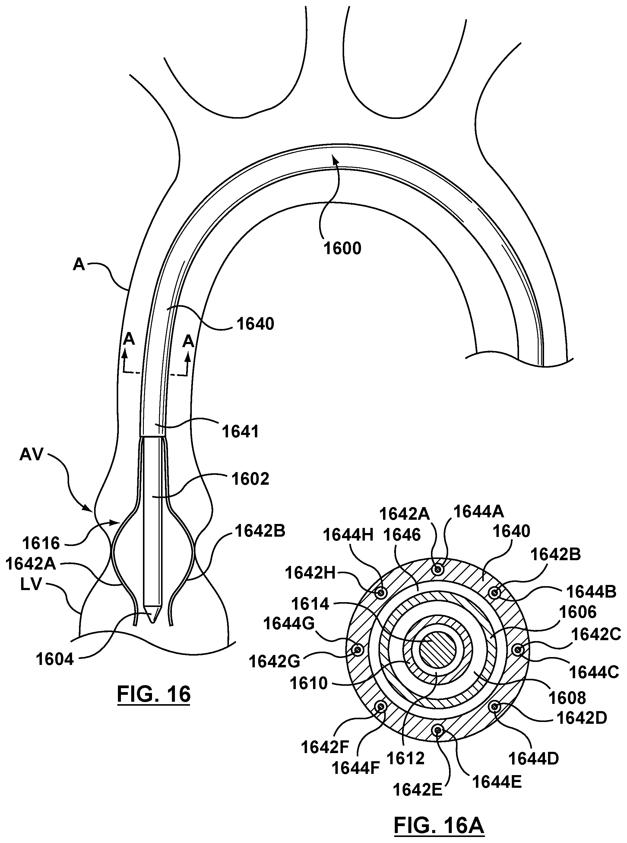 Patent US12102530 Figure 11 – Delivery system having an integral centering mechanism for positioning a valve prosthesis in situ
