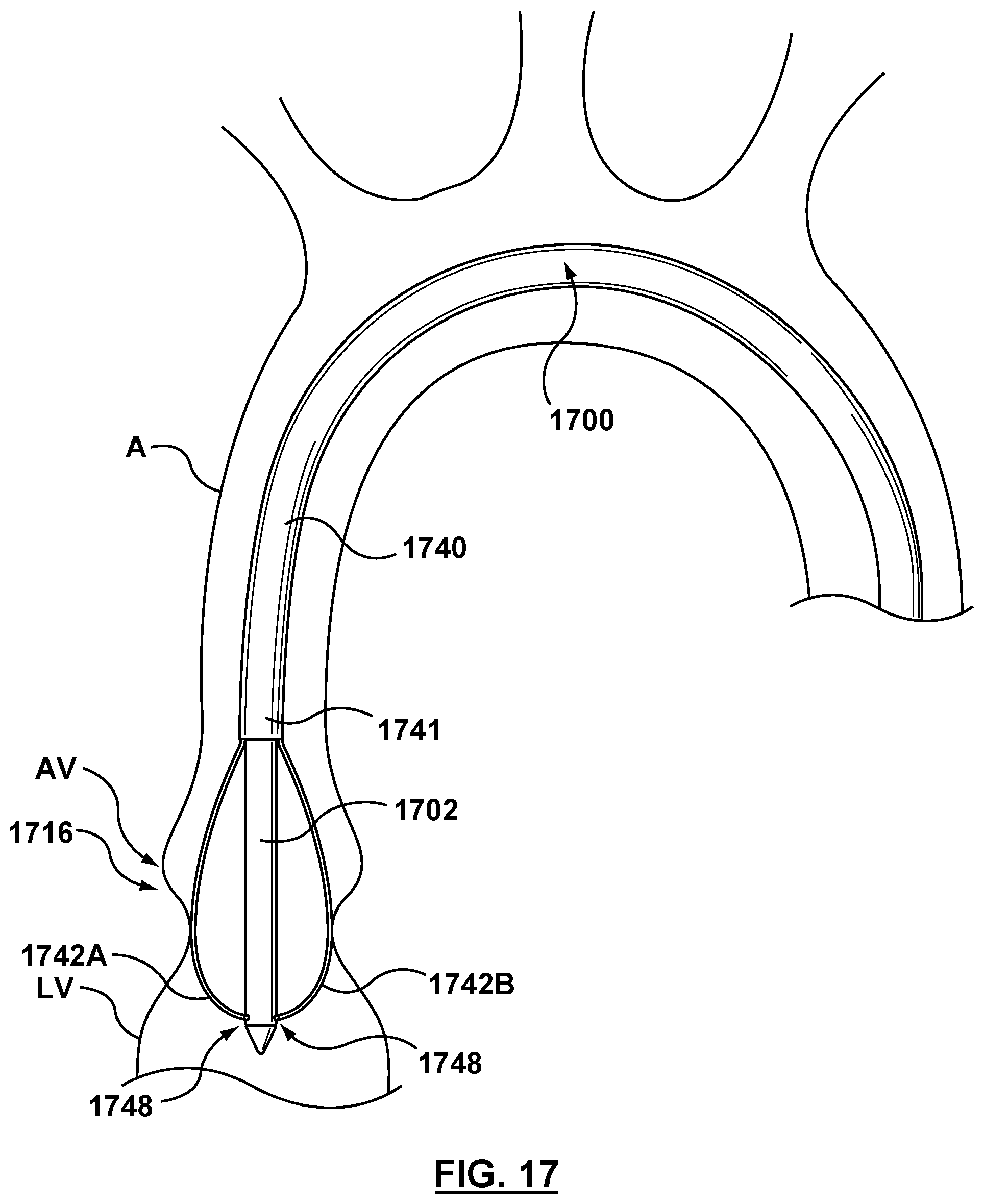 Patent US12102530 Figure 12 – Delivery system having an integral centering mechanism for positioning a valve prosthesis in situ