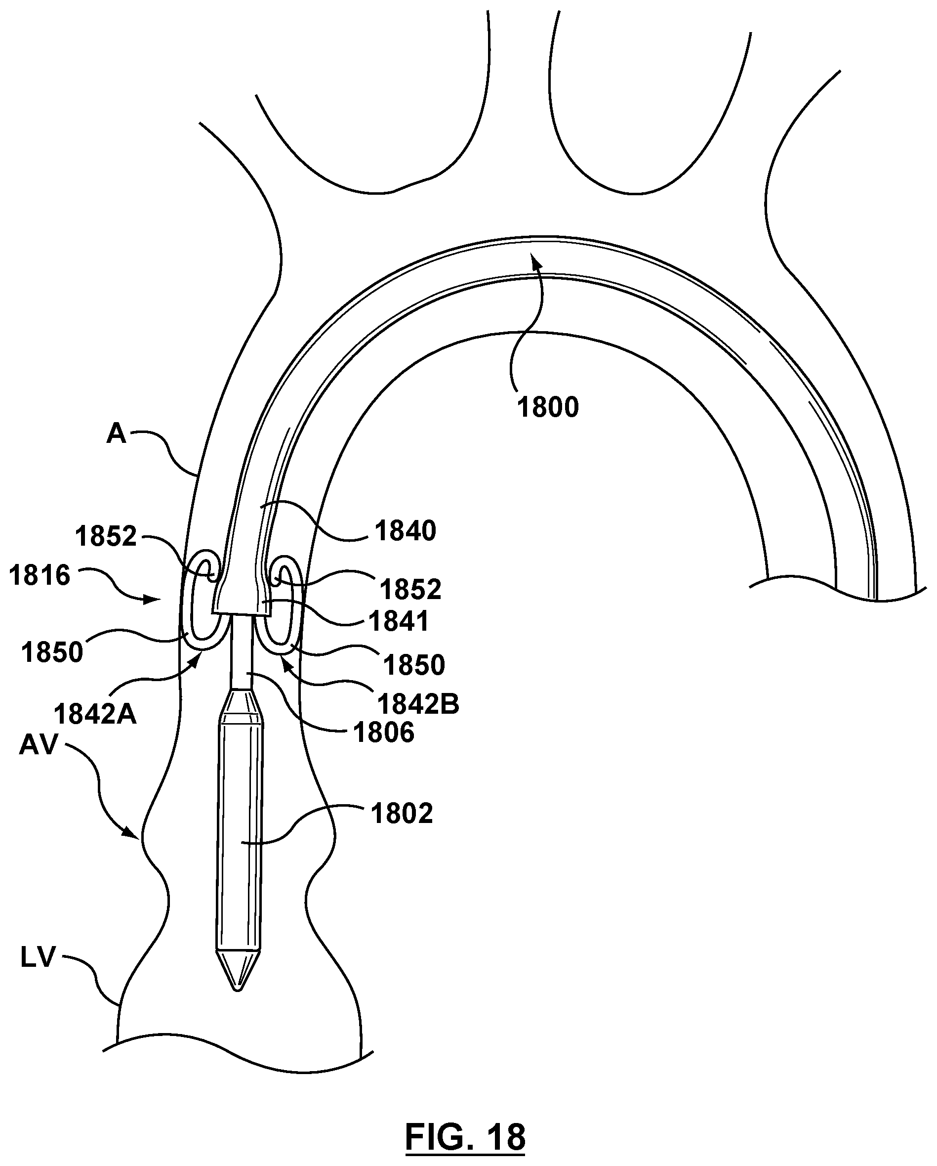 Patent US12102530 Figure 13 – Delivery system having an integral centering mechanism for positioning a valve prosthesis in situ