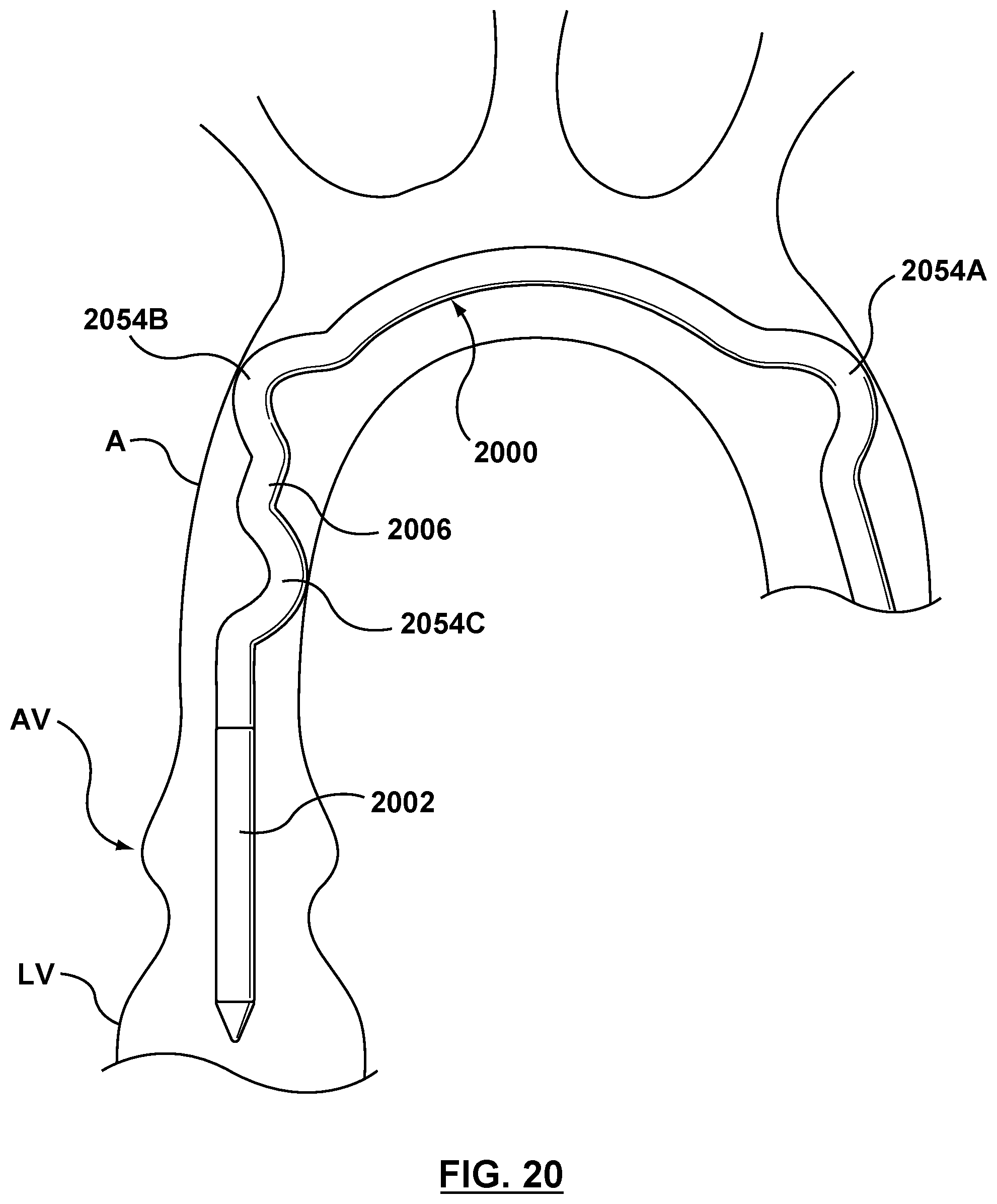 Patent US12102530 Figure 15 – Delivery system having an integral centering mechanism for positioning a valve prosthesis in situ