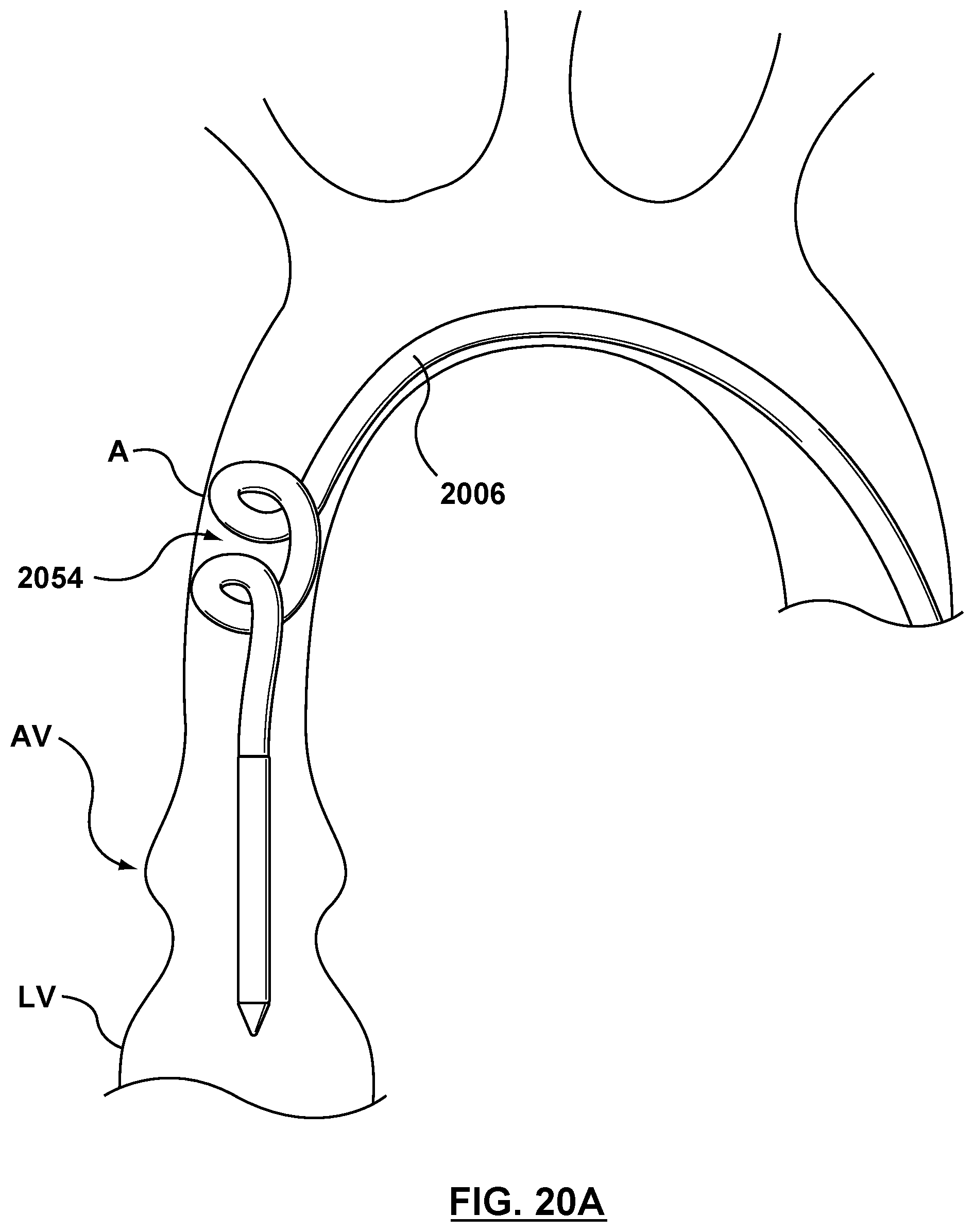 Patent US12102530 Figure 16 – Delivery system having an integral centering mechanism for positioning a valve prosthesis in situ