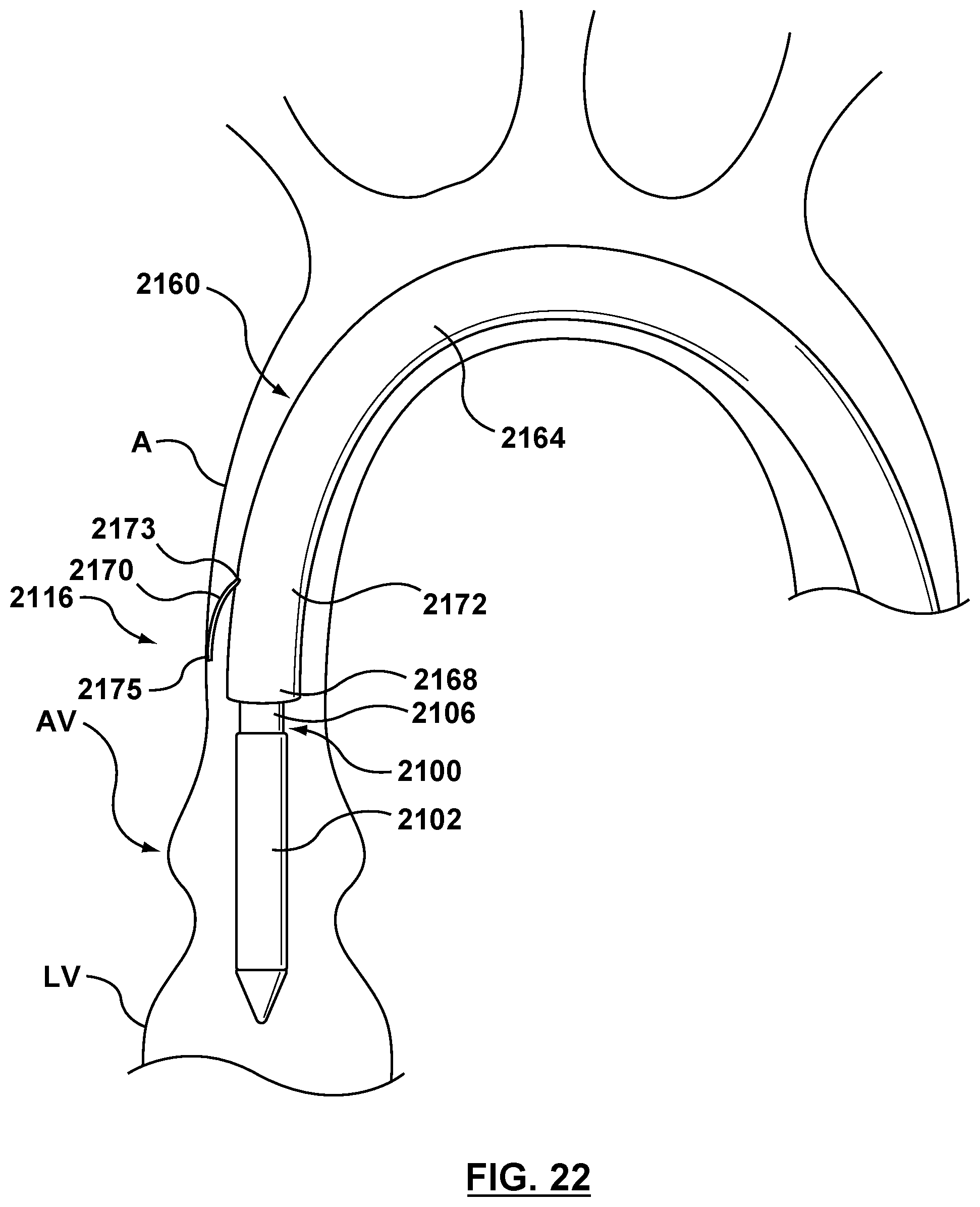 Patent US12102530 Figure 19 – Delivery system having an integral centering mechanism for positioning a valve prosthesis in situ