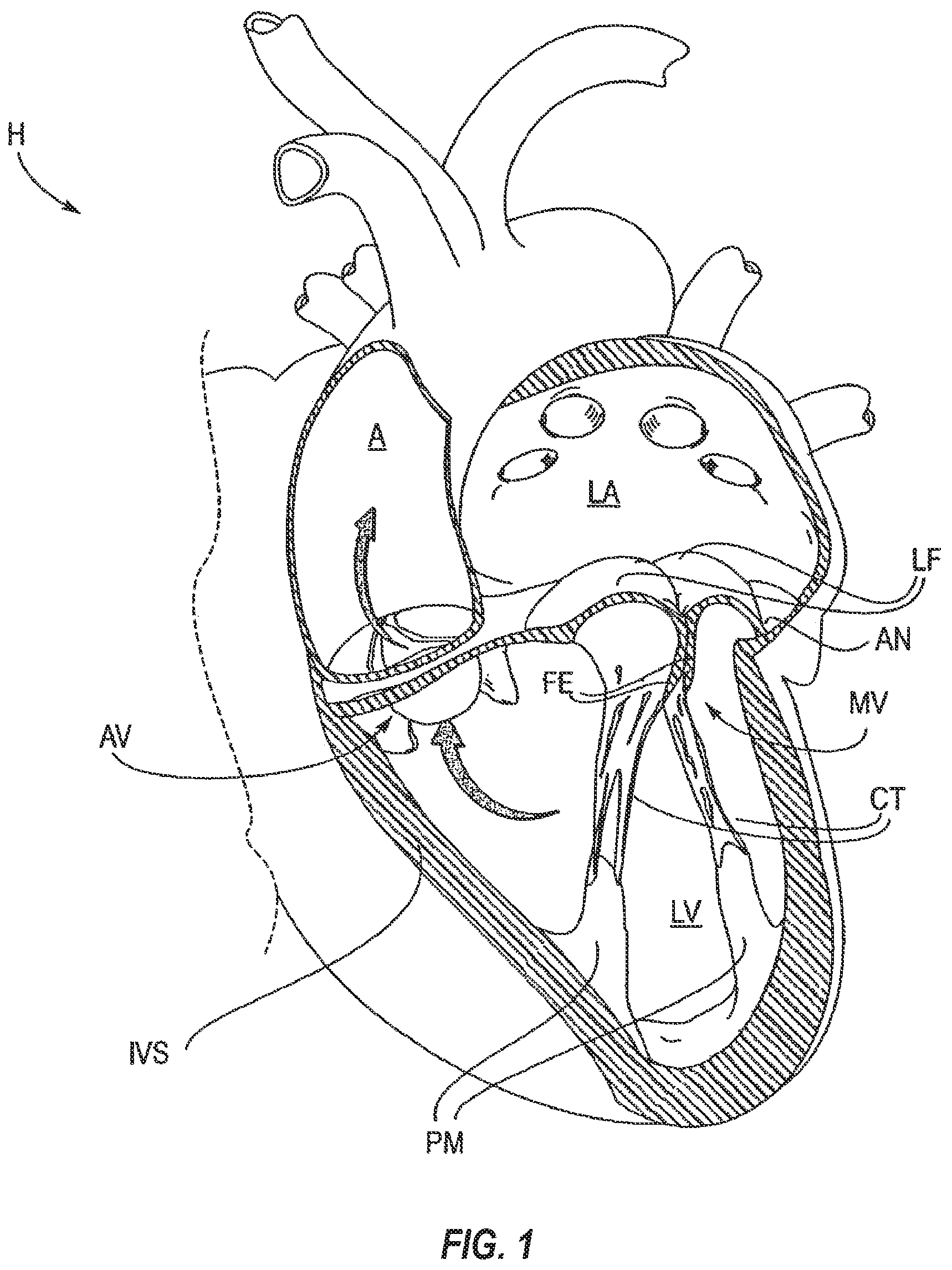 Patent US12102531 Figure 1 – Tissue cutting systems, devices and methods