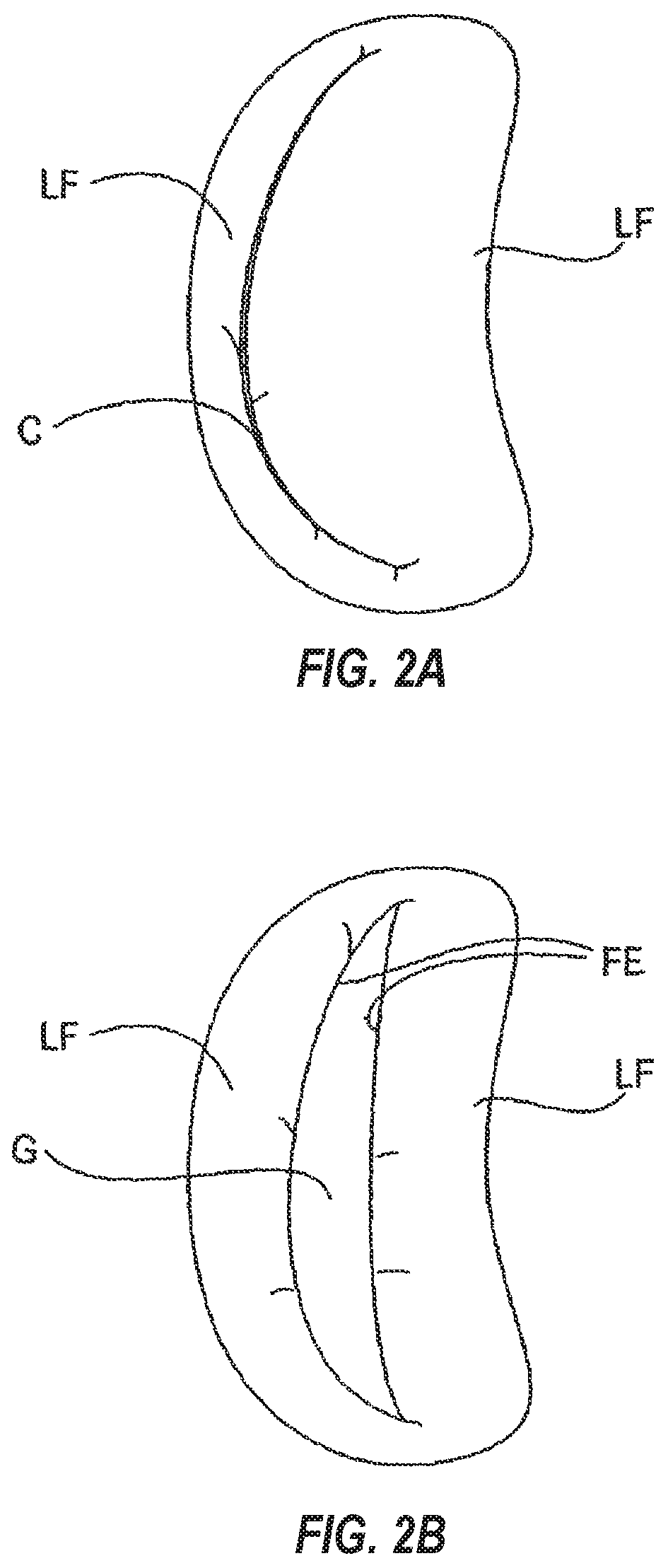 Patent US12102531 Figure 2 – Tissue cutting systems, devices and methods