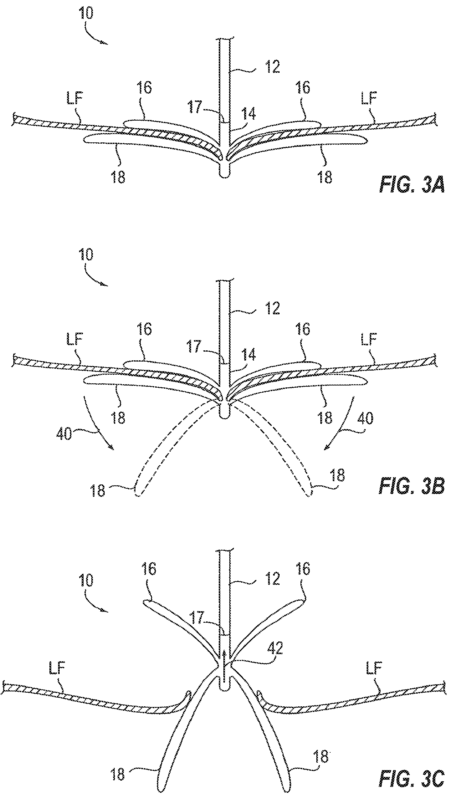 Patent US12102531 Figure 3 – Tissue cutting systems, devices and methods