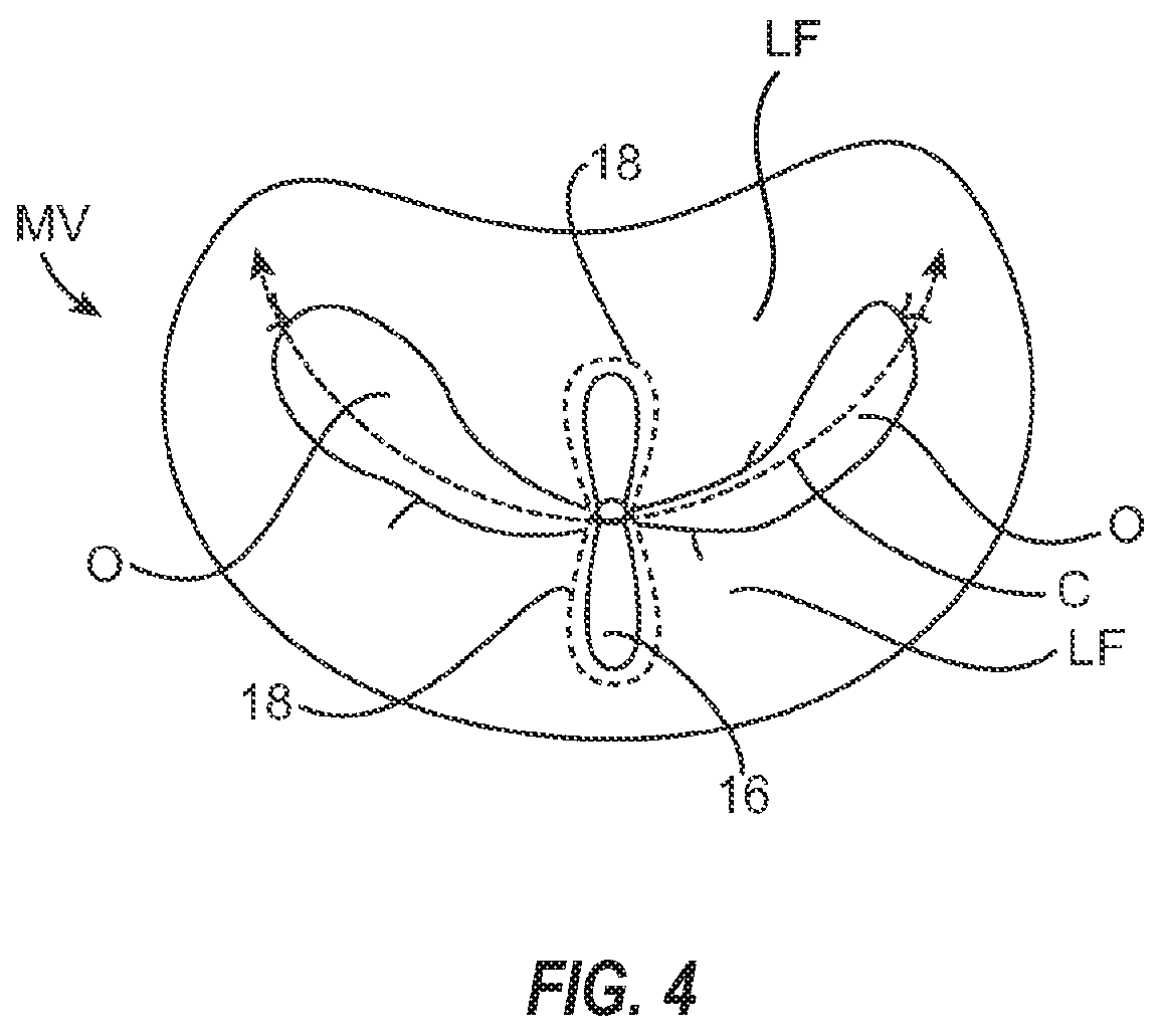 Patent US12102531 Figure 4 – Tissue cutting systems, devices and methods