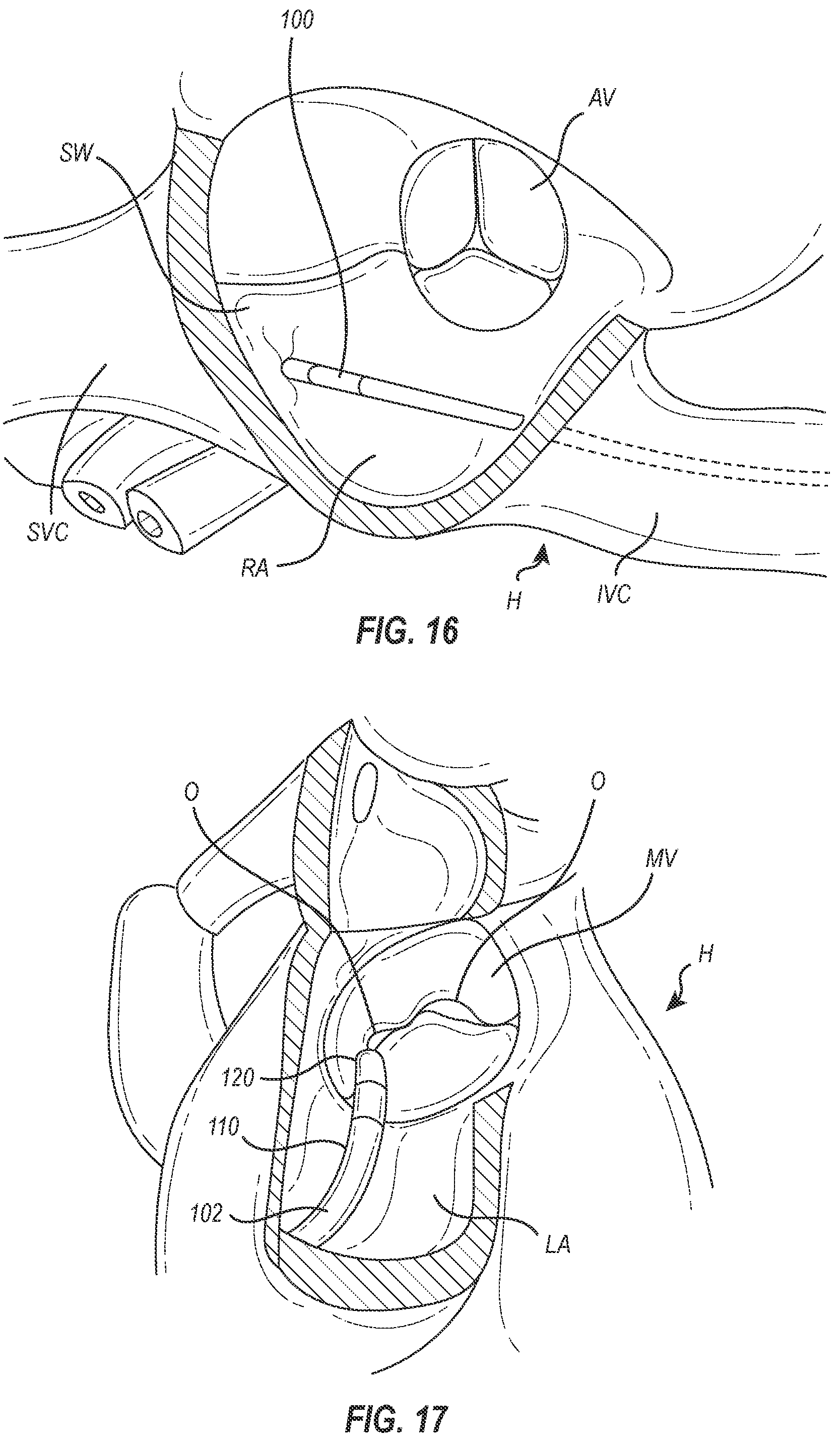 Patent US12102531 Figure 10 – Tissue cutting systems, devices and methods