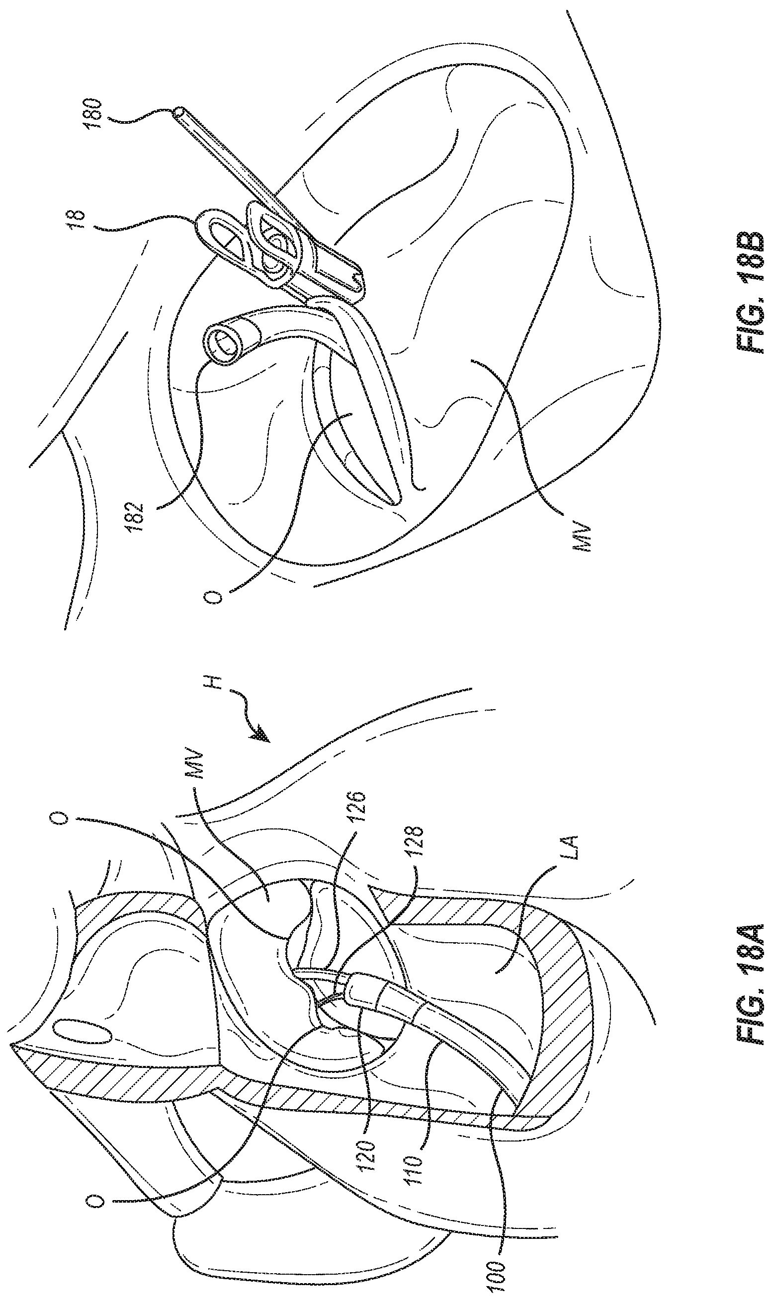 Patent US12102531 Figure 11 – Tissue cutting systems, devices and methods
