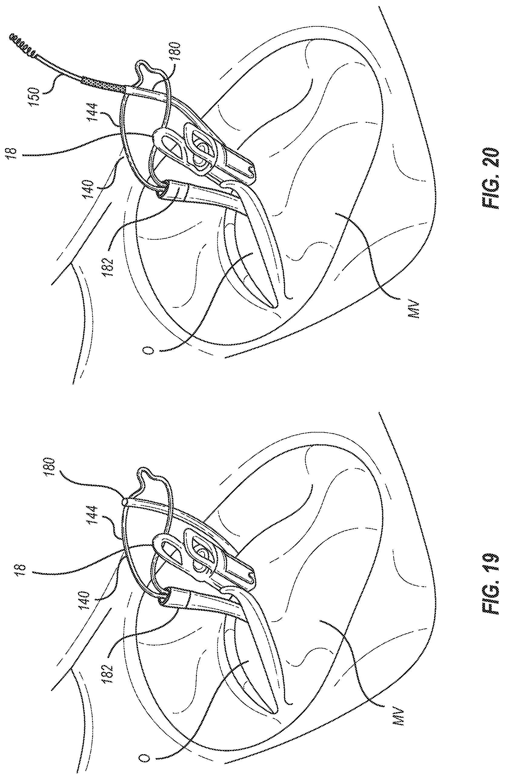 Patent US12102531 Figure 12 – Tissue cutting systems, devices and methods
