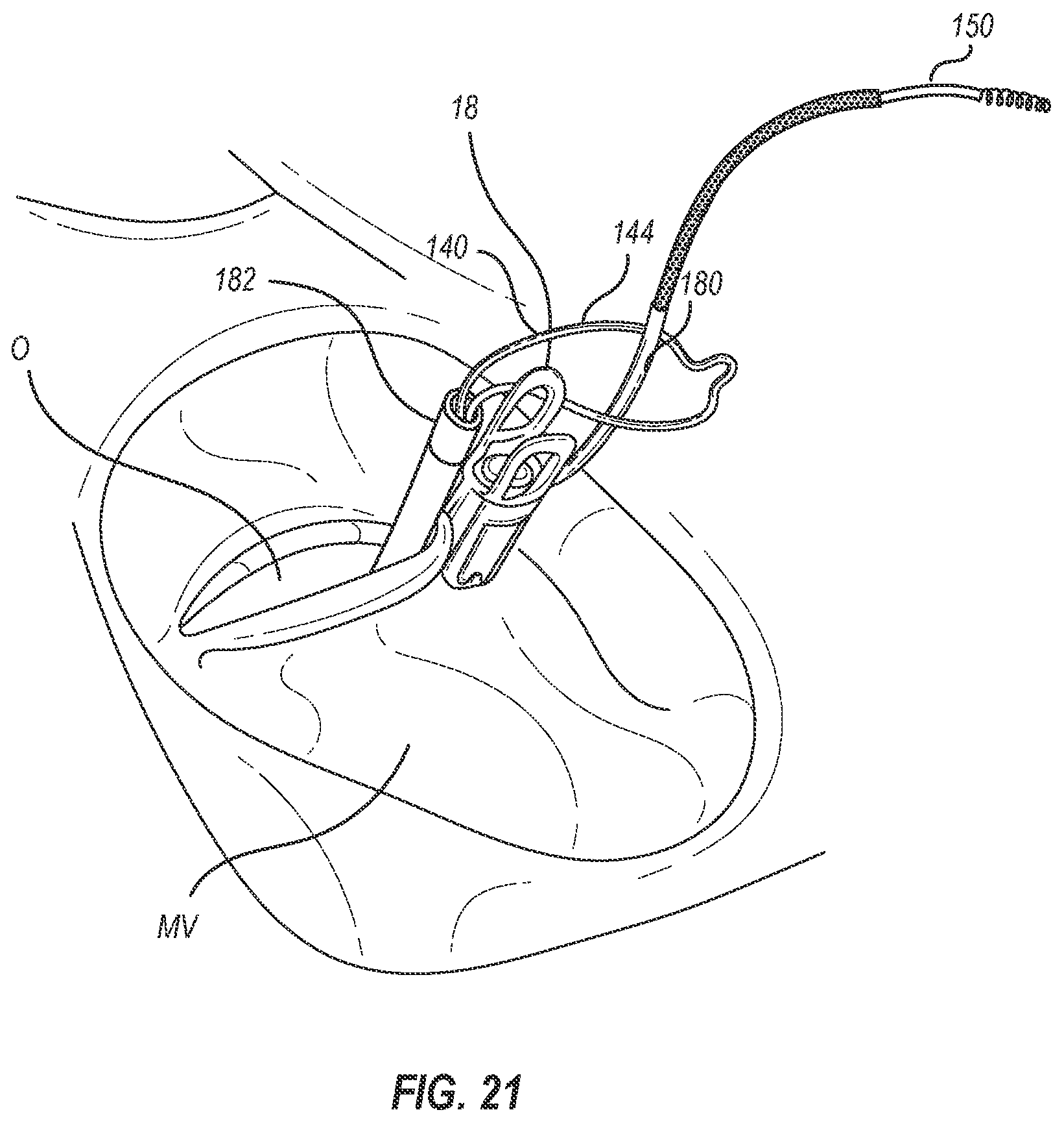 Patent US12102531 Figure 13 – Tissue cutting systems, devices and methods