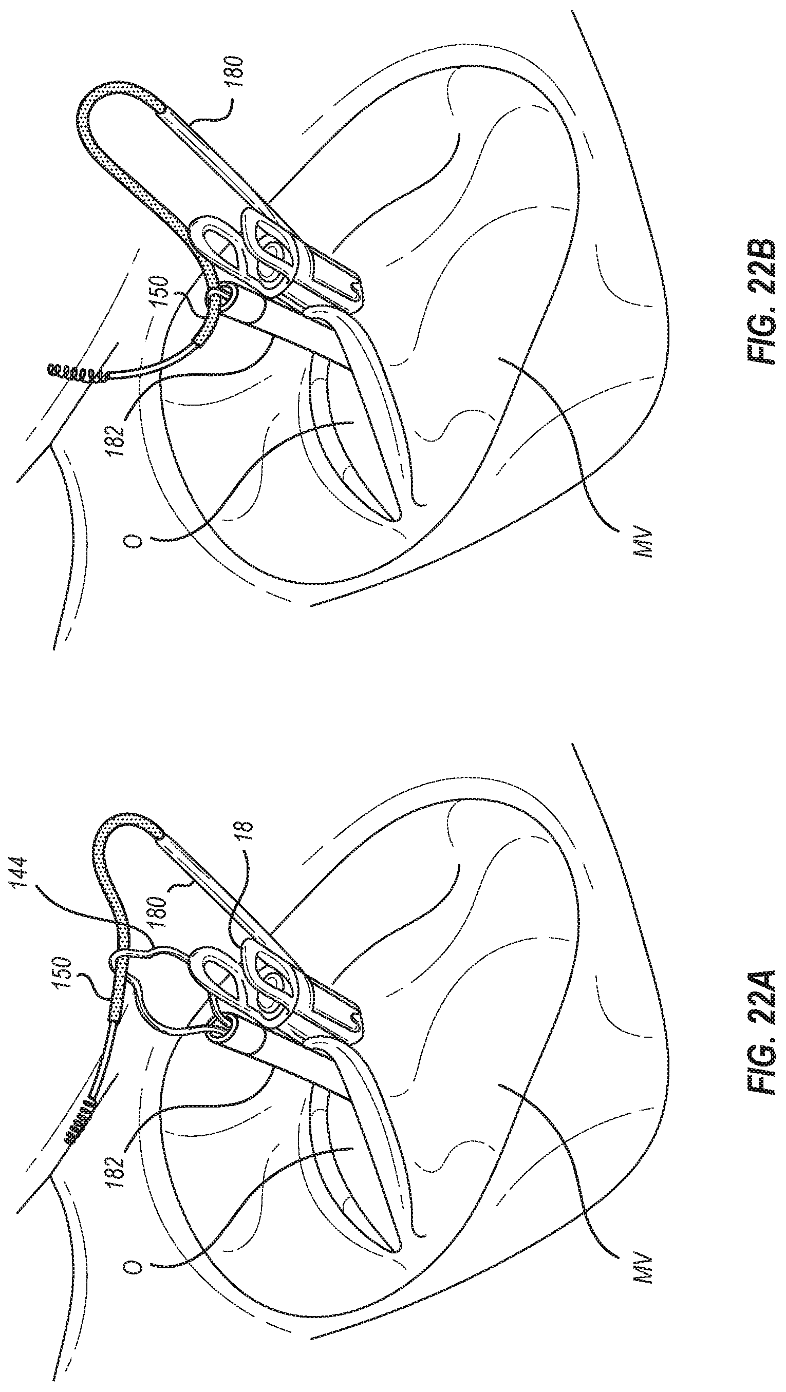 Patent US12102531 Figure 14 – Tissue cutting systems, devices and methods