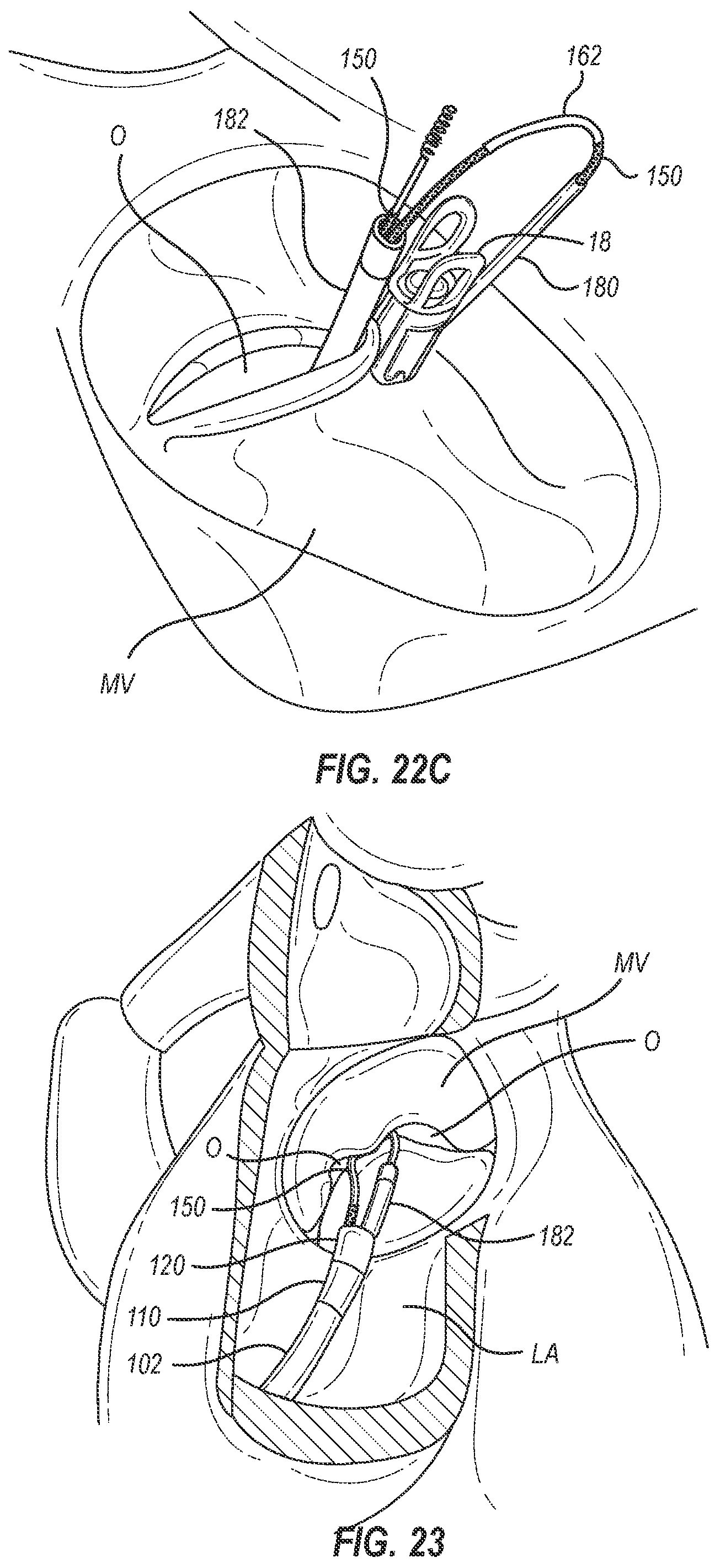 Patent US12102531 Figure 15 – Tissue cutting systems, devices and methods