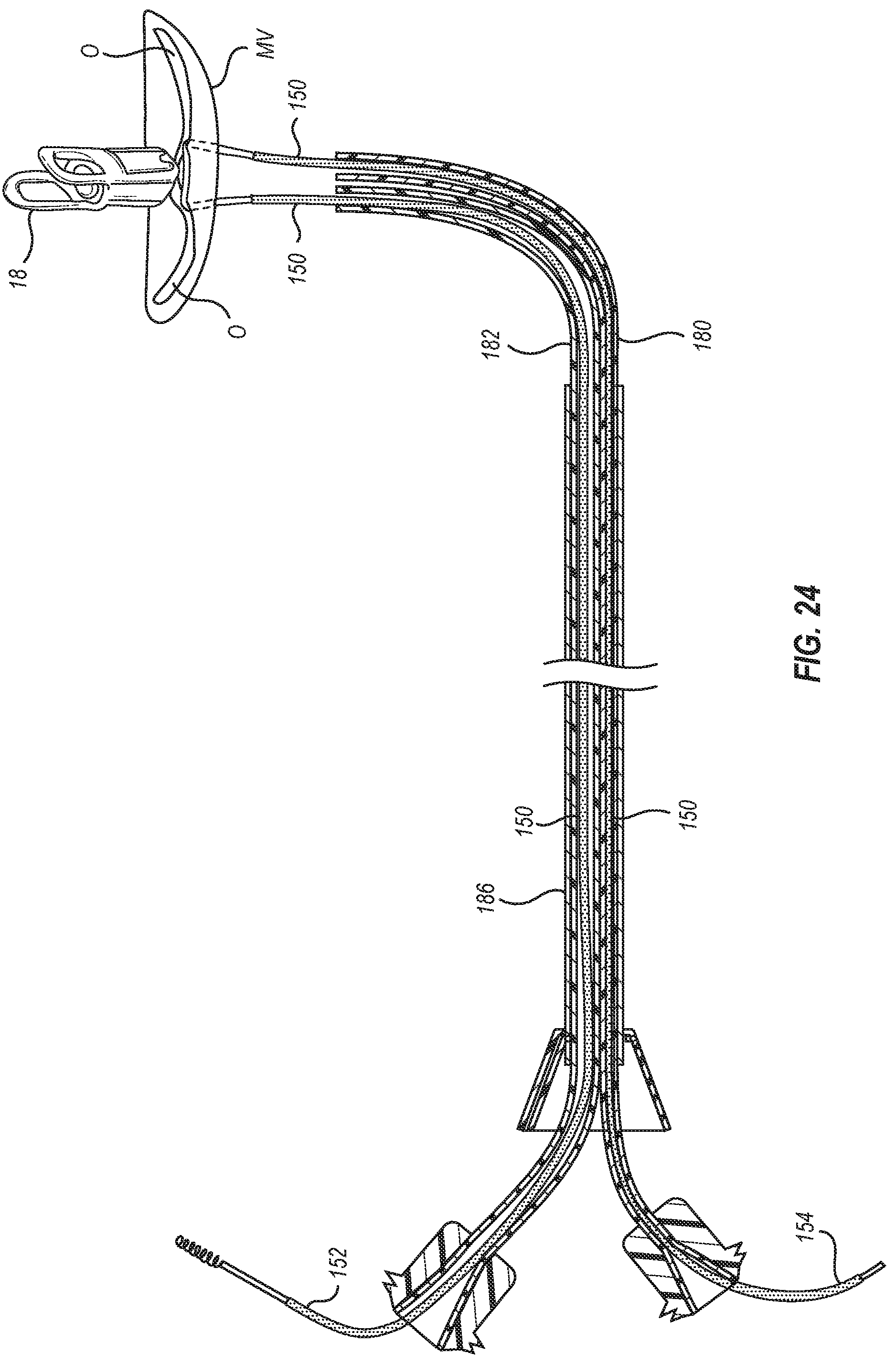 Patent US12102531 Figure 16 – Tissue cutting systems, devices and methods