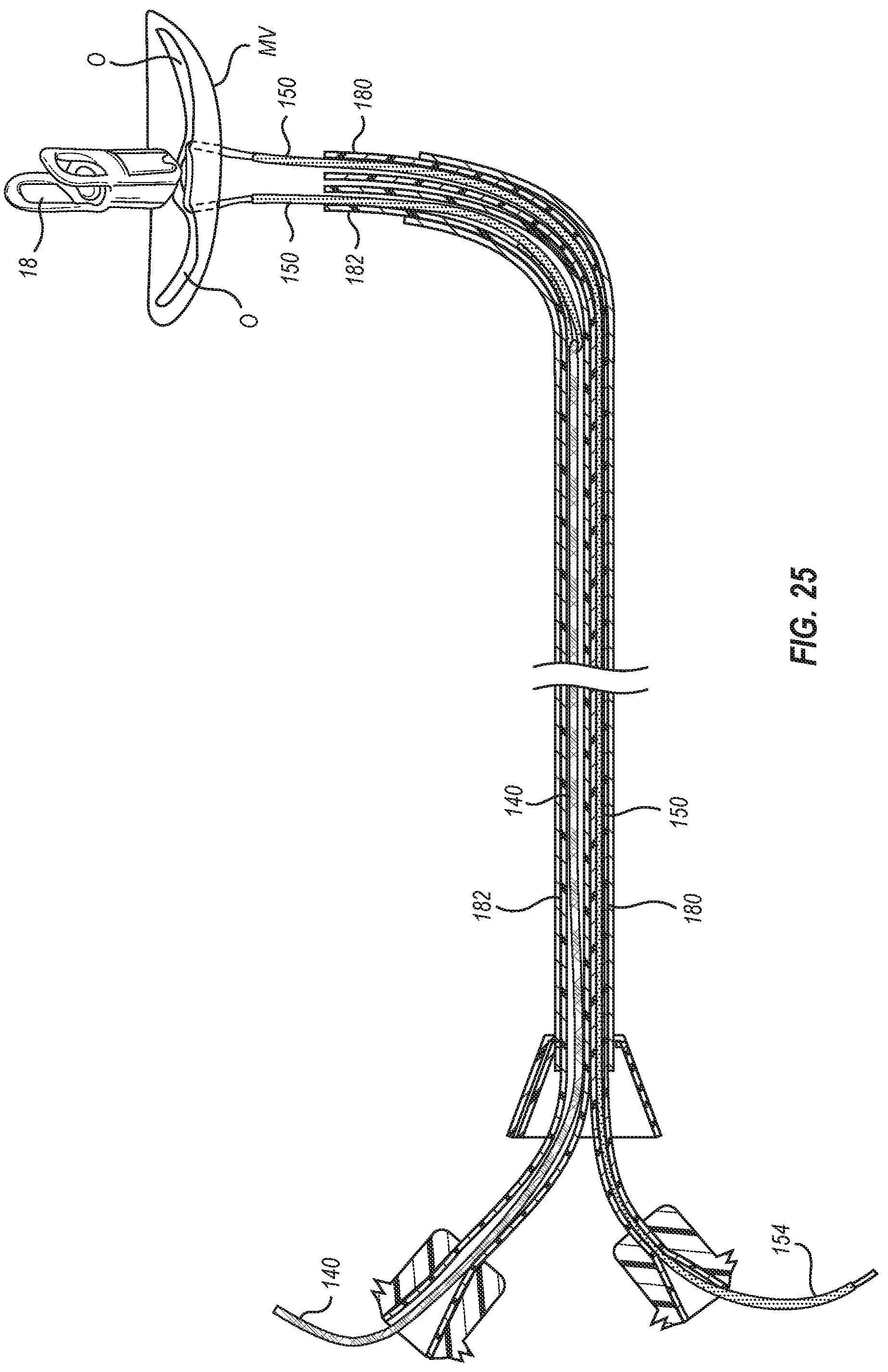 Patent US12102531 Figure 17 – Tissue cutting systems, devices and methods