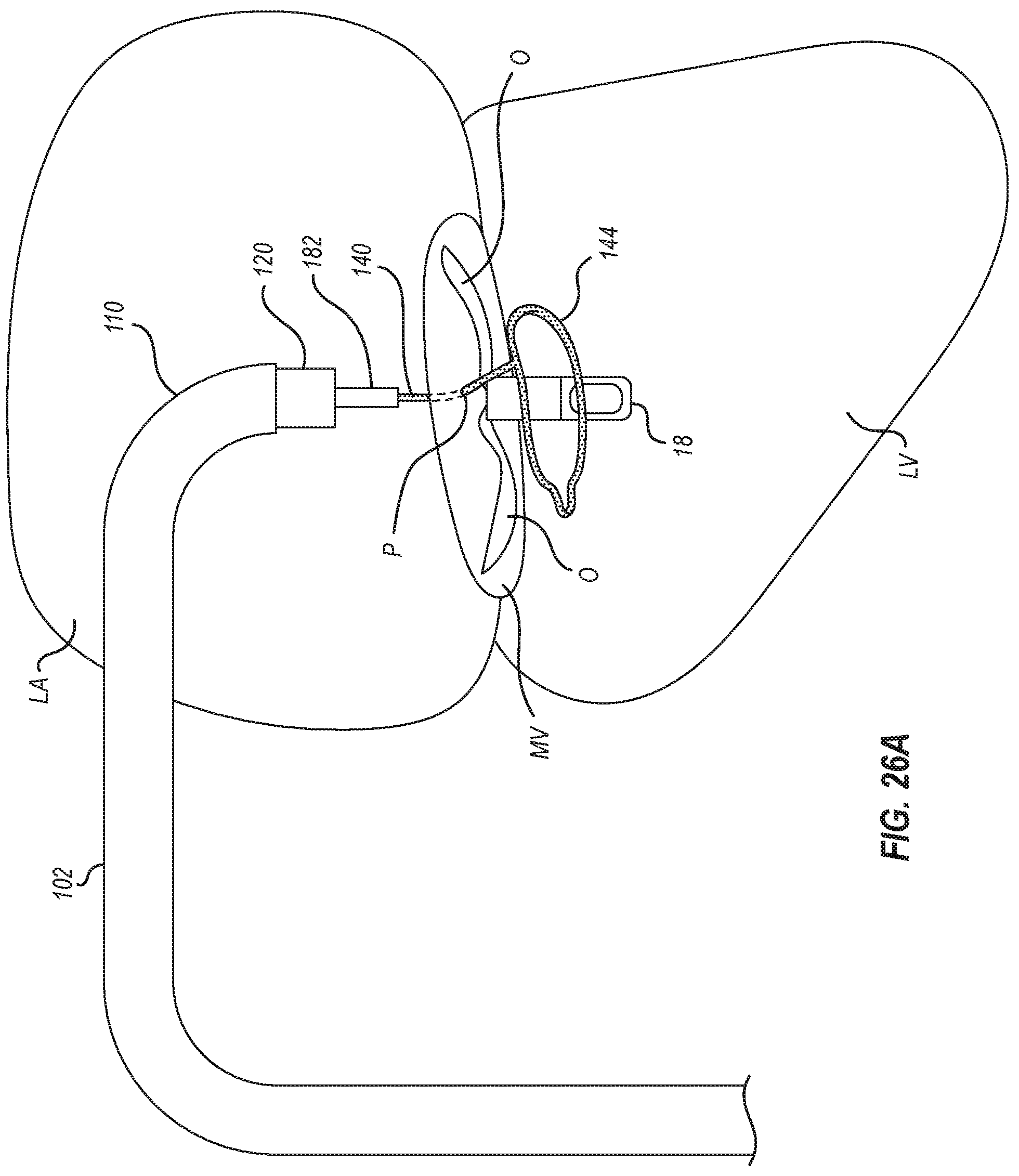 Patent US12102531 Figure 18 – Tissue cutting systems, devices and methods