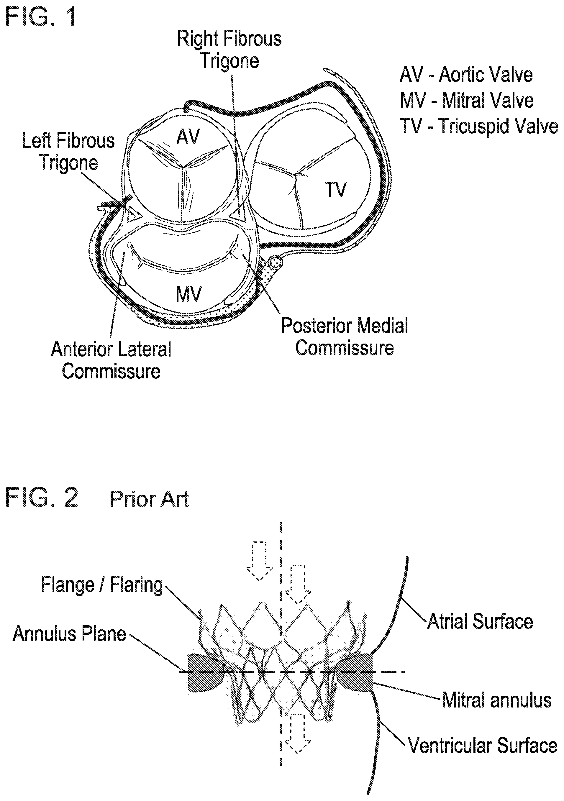 Patent US12102532 Figure 1 – Systems and methods for treating luminal valves