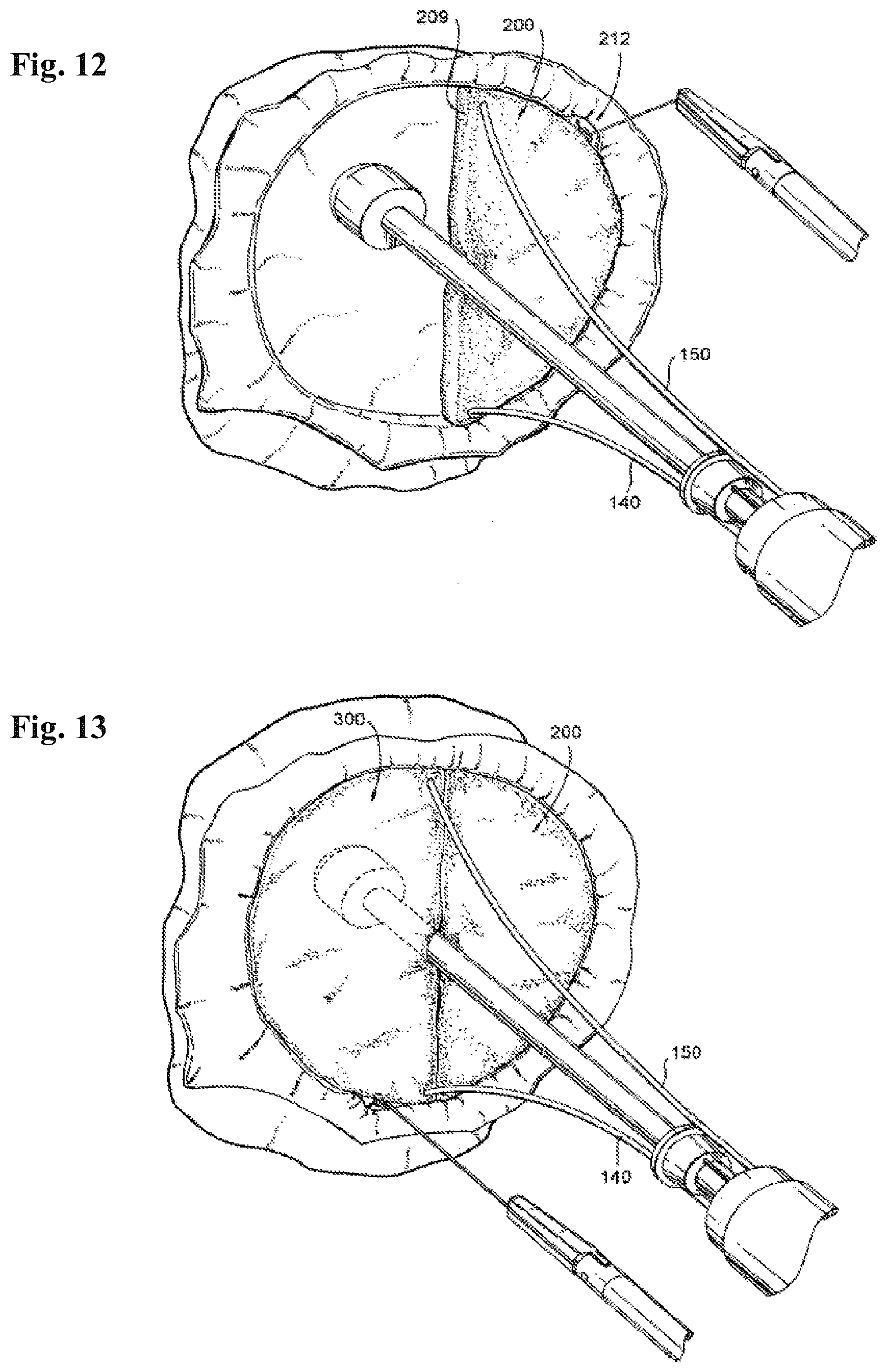 Patent US12102532 Figure 10 – Systems and methods for treating luminal valves