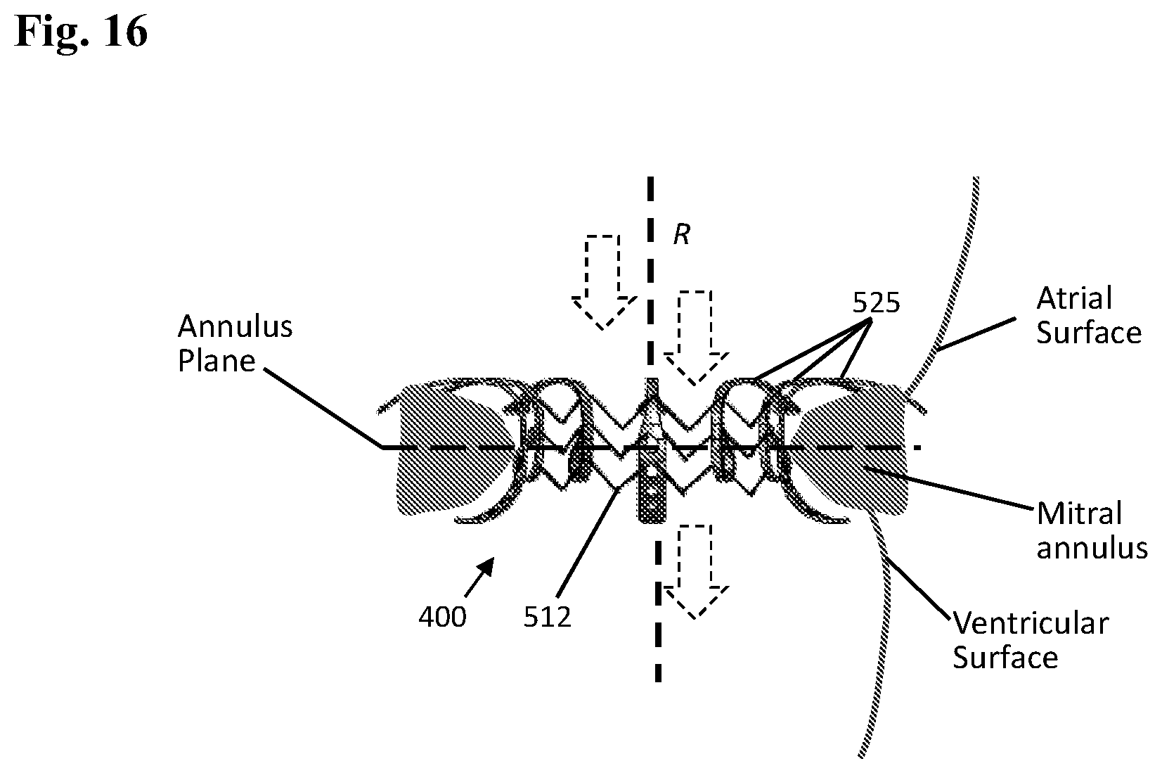 Patent US12102532 Figure 14 – Systems and methods for treating luminal valves