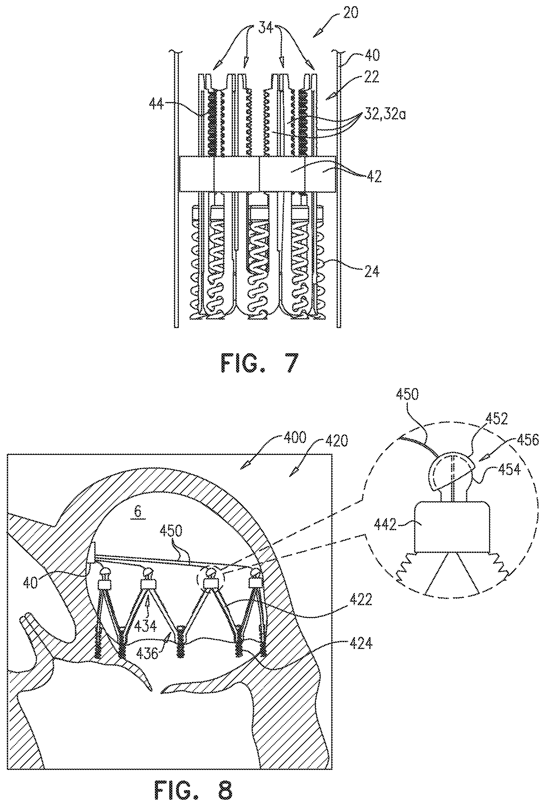Patent US12102533 Figure 7 – Adjustable annuloplasty device with alternating peaks and troughs