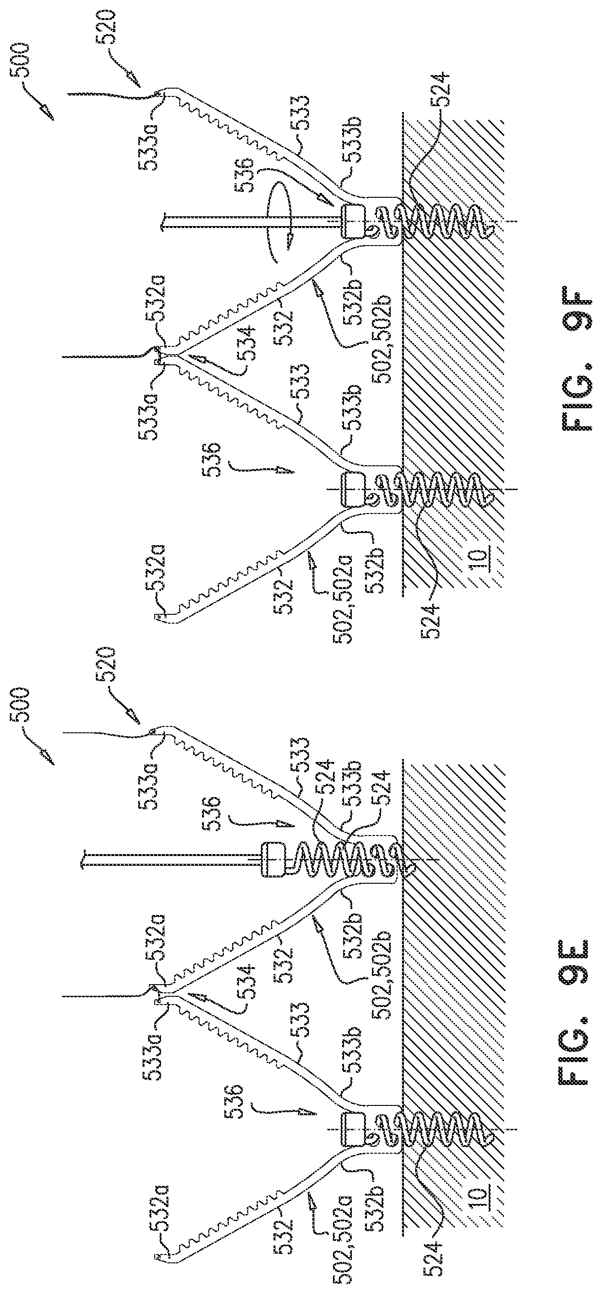 Patent US12102533 Figure 9 – Adjustable annuloplasty device with alternating peaks and troughs