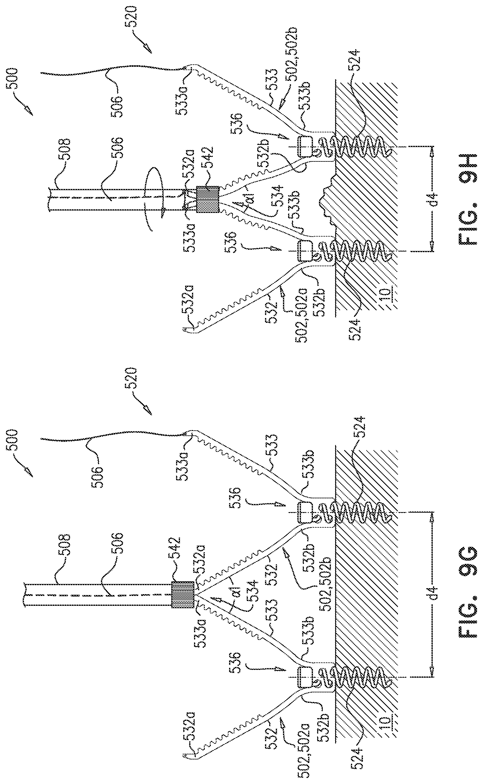 Patent US12102533 Figure 10 – Adjustable annuloplasty device with alternating peaks and troughs