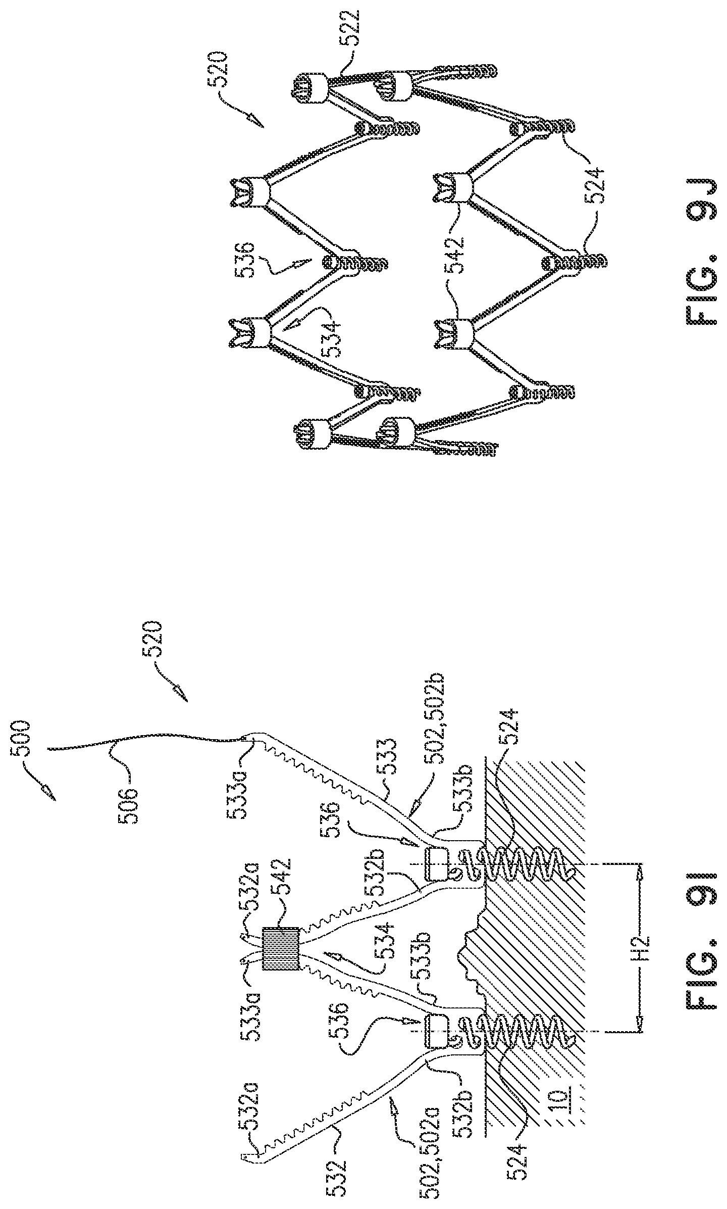 Patent US12102533 Figure 11 – Adjustable annuloplasty device with alternating peaks and troughs