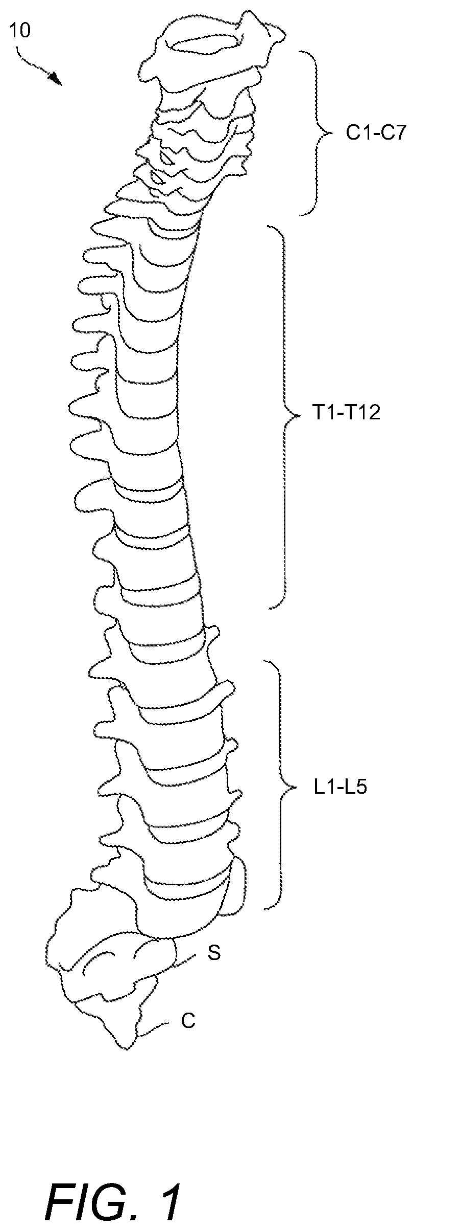 Patent US12102537 Figure 1 – Minimally invasive expandable intervertebral fusion implant